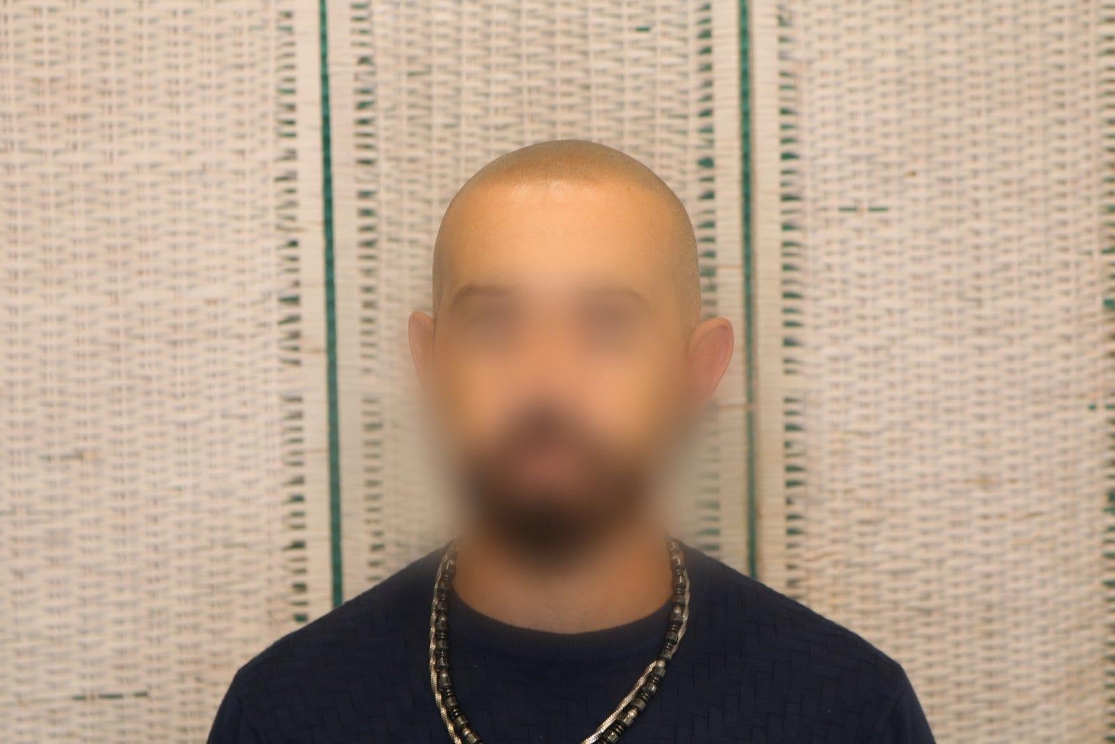 Tricopigmentazione, dopo, caso #37, Firenze