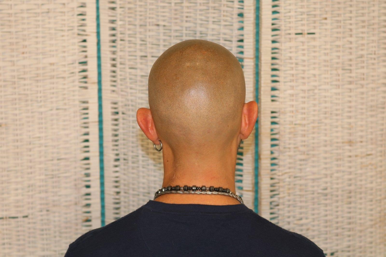 Dopo: tricopigmentazione effetto rasato a Firenze — Caso Prima / Dopo #37 (foto 2)