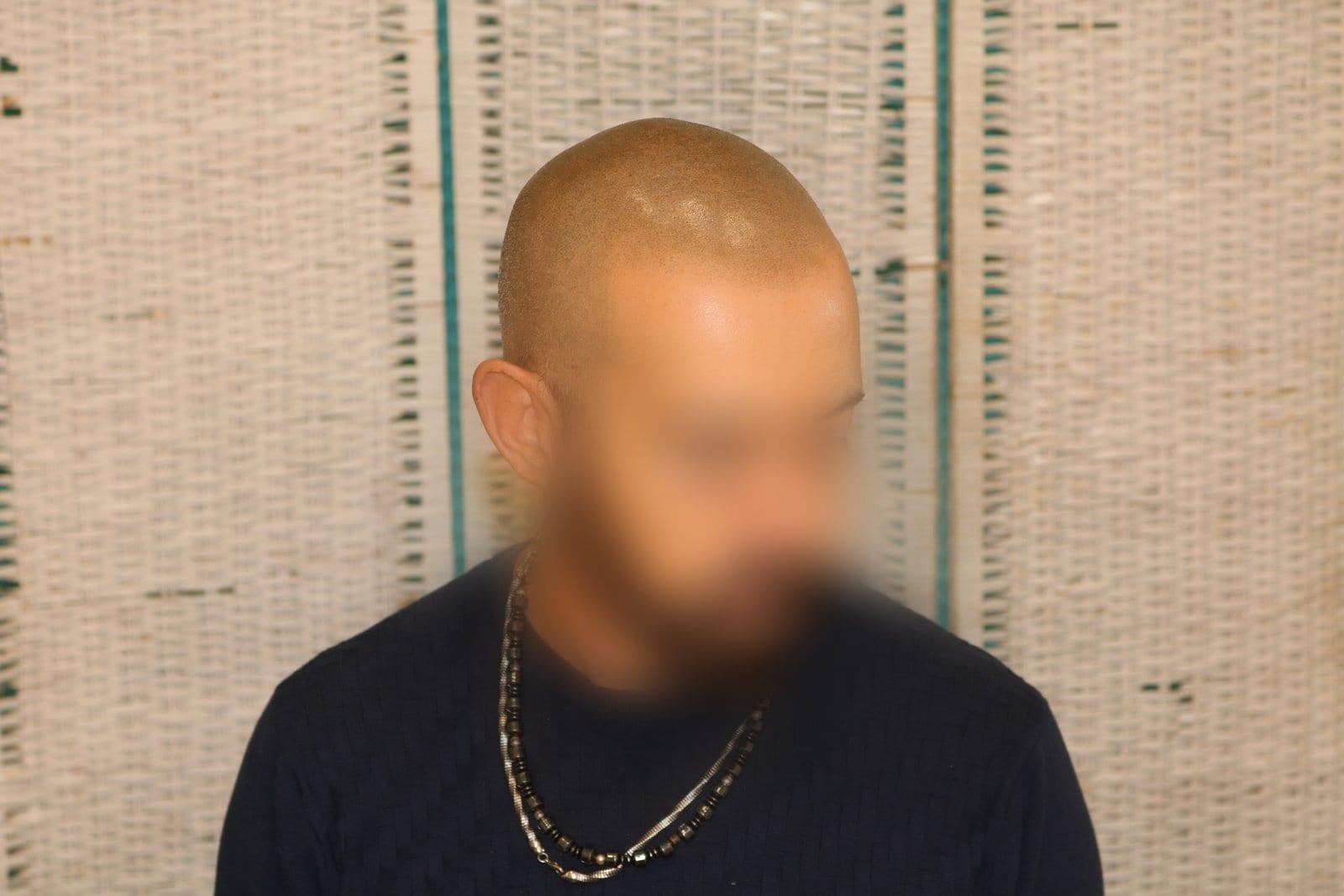 Dopo: tricopigmentazione effetto rasato a Firenze — Caso Prima / Dopo #37 (foto 3)