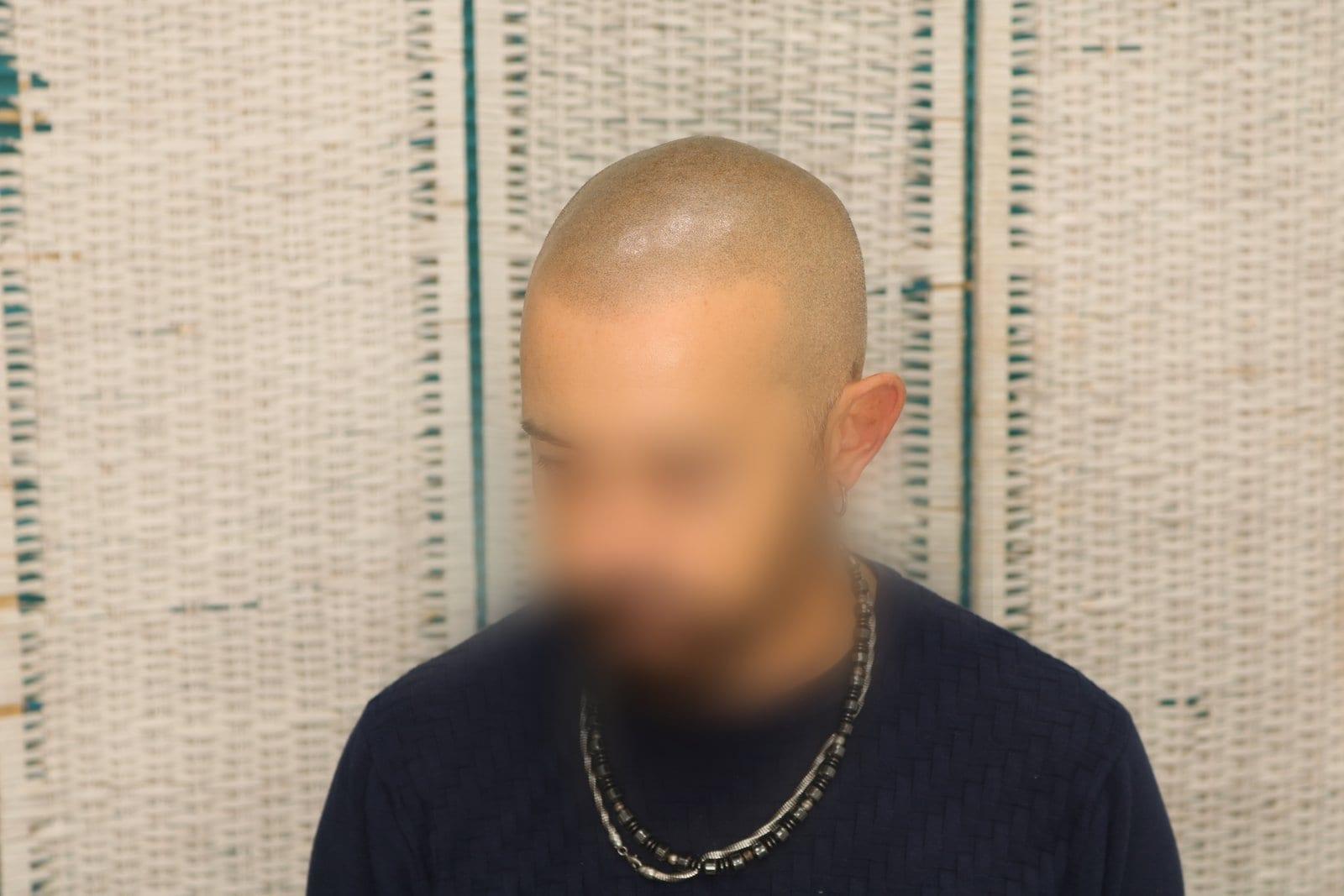 Dopo: tricopigmentazione effetto rasato a Firenze — Caso Prima / Dopo #37 (foto 4)