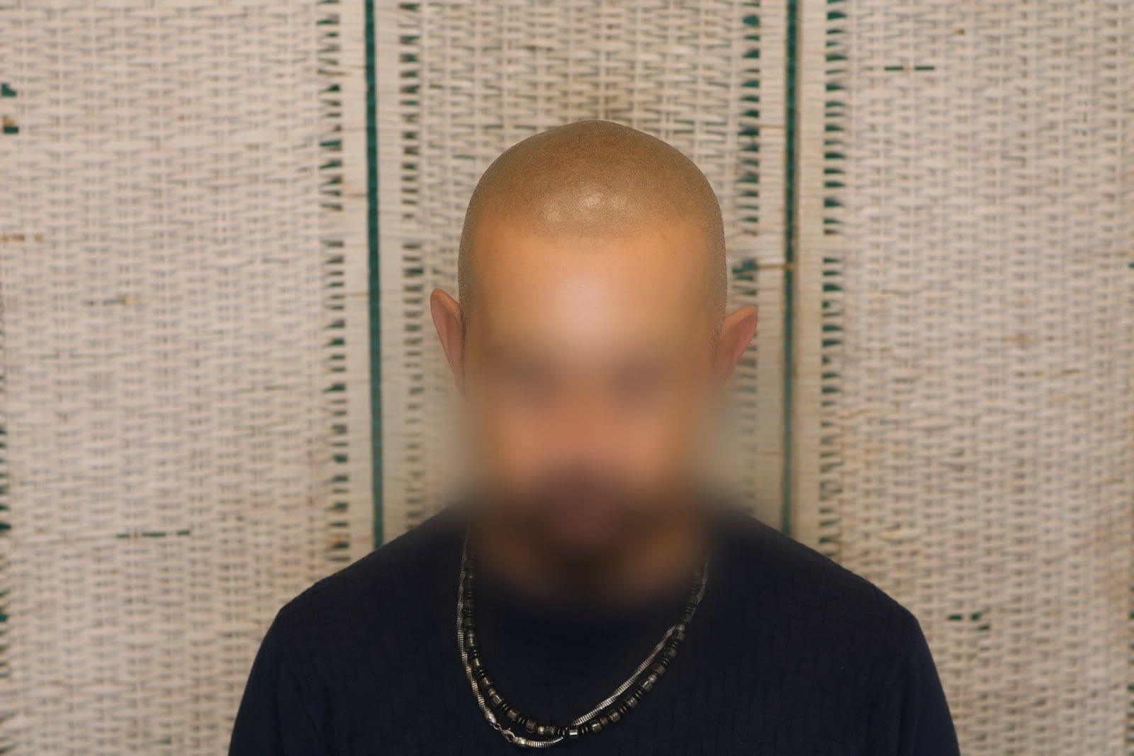 Dopo: tricopigmentazione effetto rasato a Firenze — Caso Prima / Dopo #37 (foto 5)