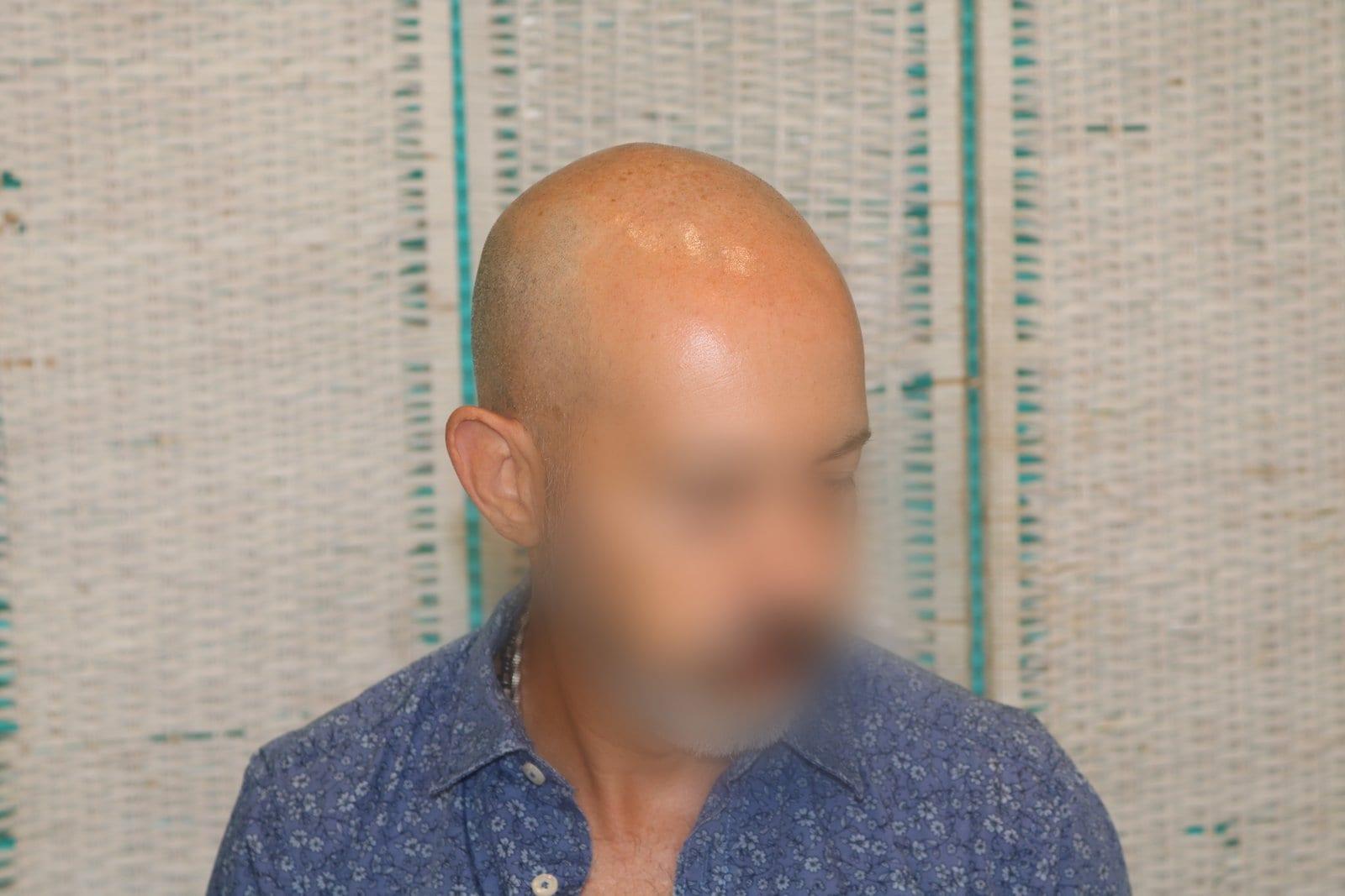 Prima: tricopigmentazione effetto rasato a Firenze — Caso Prima / Dopo #37 (foto 2)