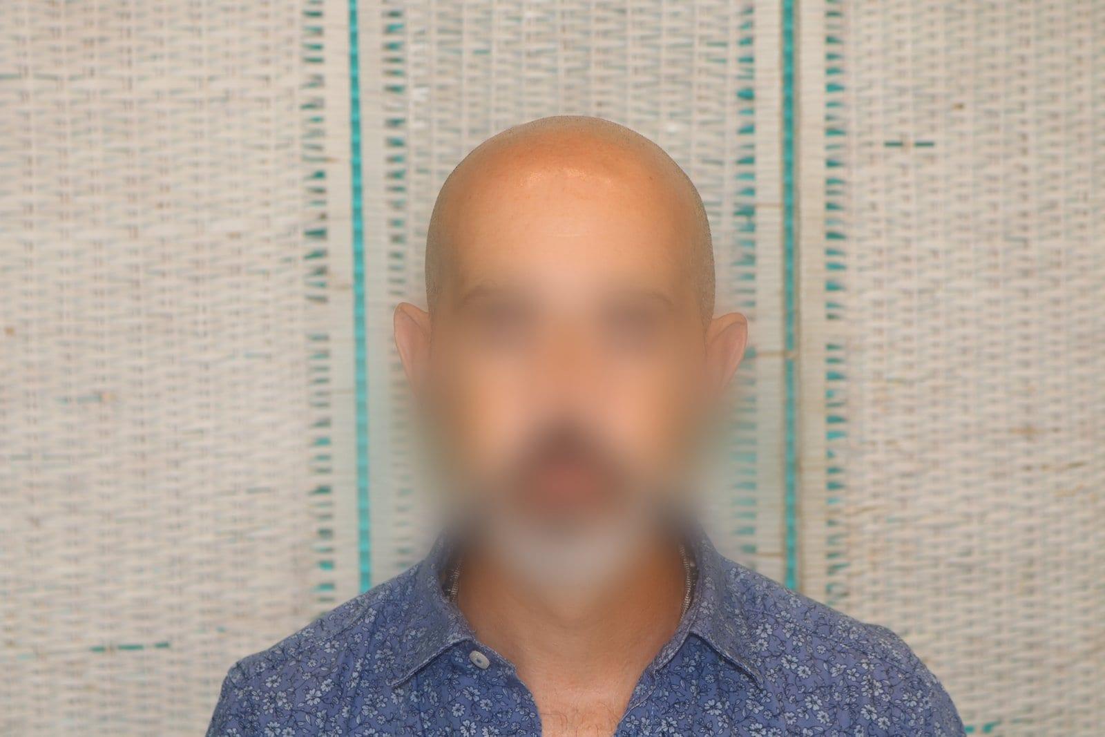 Prima: tricopigmentazione effetto rasato a Firenze — Caso Prima / Dopo #37 (foto 3)