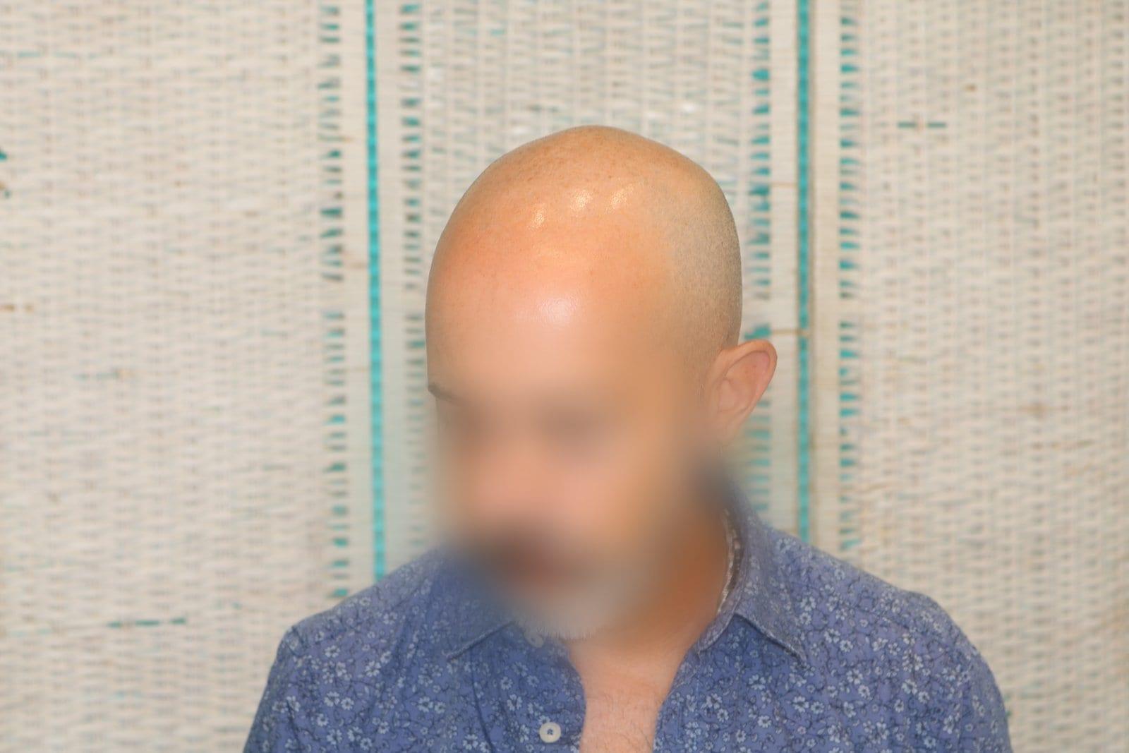 Prima: tricopigmentazione effetto rasato a Firenze — Caso Prima / Dopo #37 (foto 4)