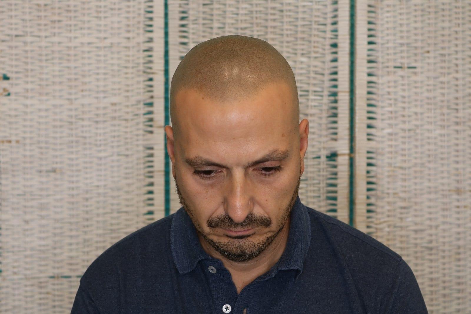 Tricopigmentazione, dopo, caso #38, Firenze