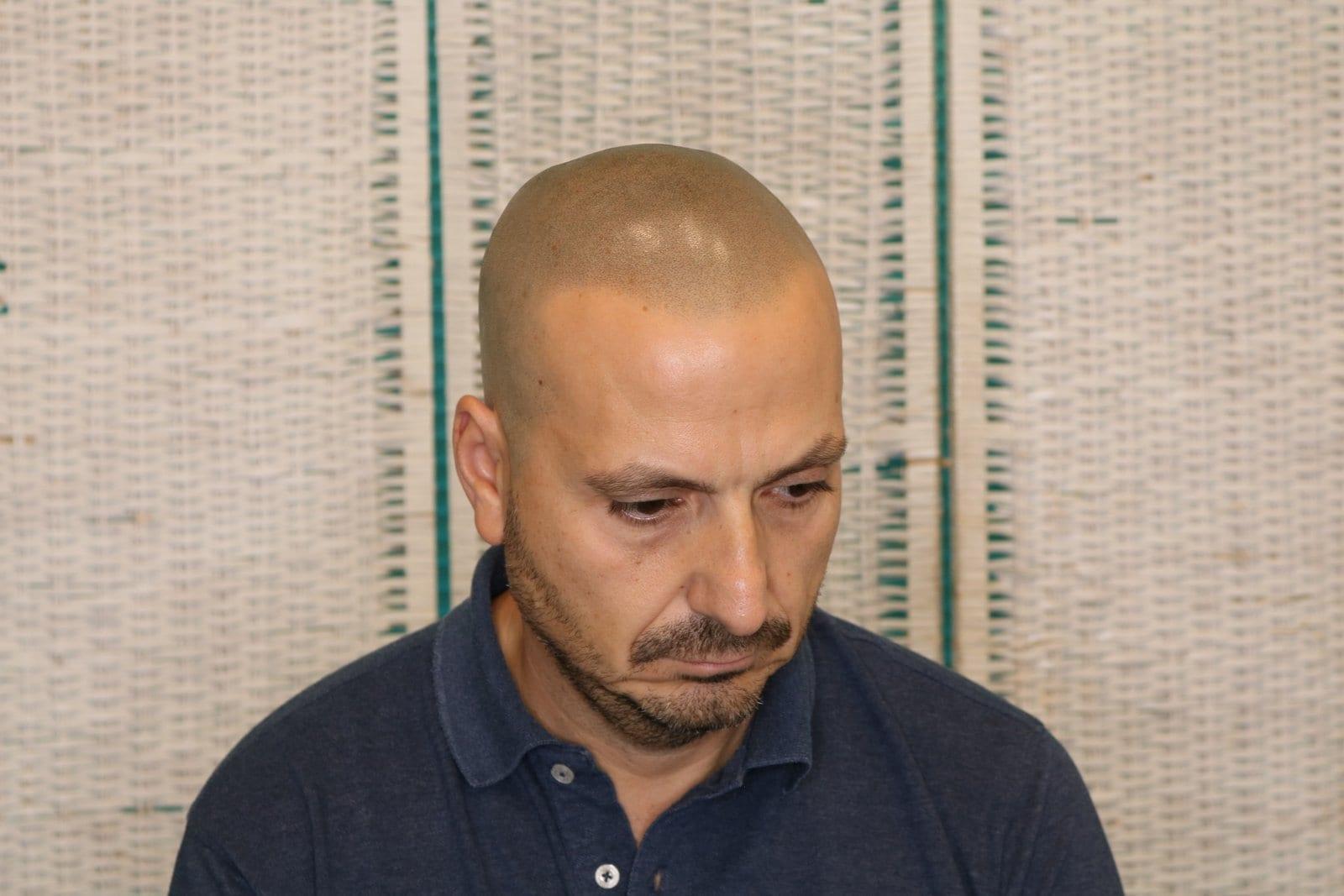 Dopo: tricopigmentazione effetto rasato a Firenze — Caso Prima / Dopo #38 (foto 2)