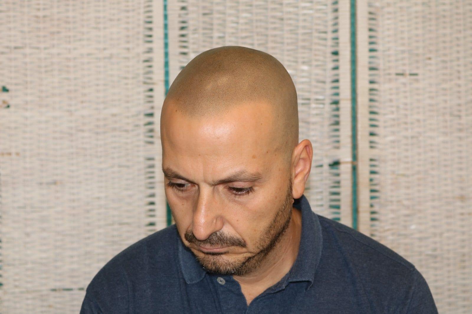 Dopo: tricopigmentazione effetto rasato a Firenze — Caso Prima / Dopo #38 (foto 3)