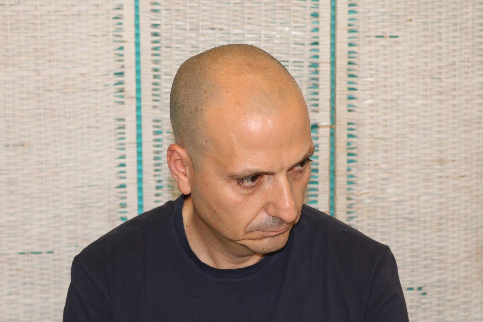 Prima: tricopigmentazione effetto rasato a Firenze — Caso Prima / Dopo #38 (foto 2)