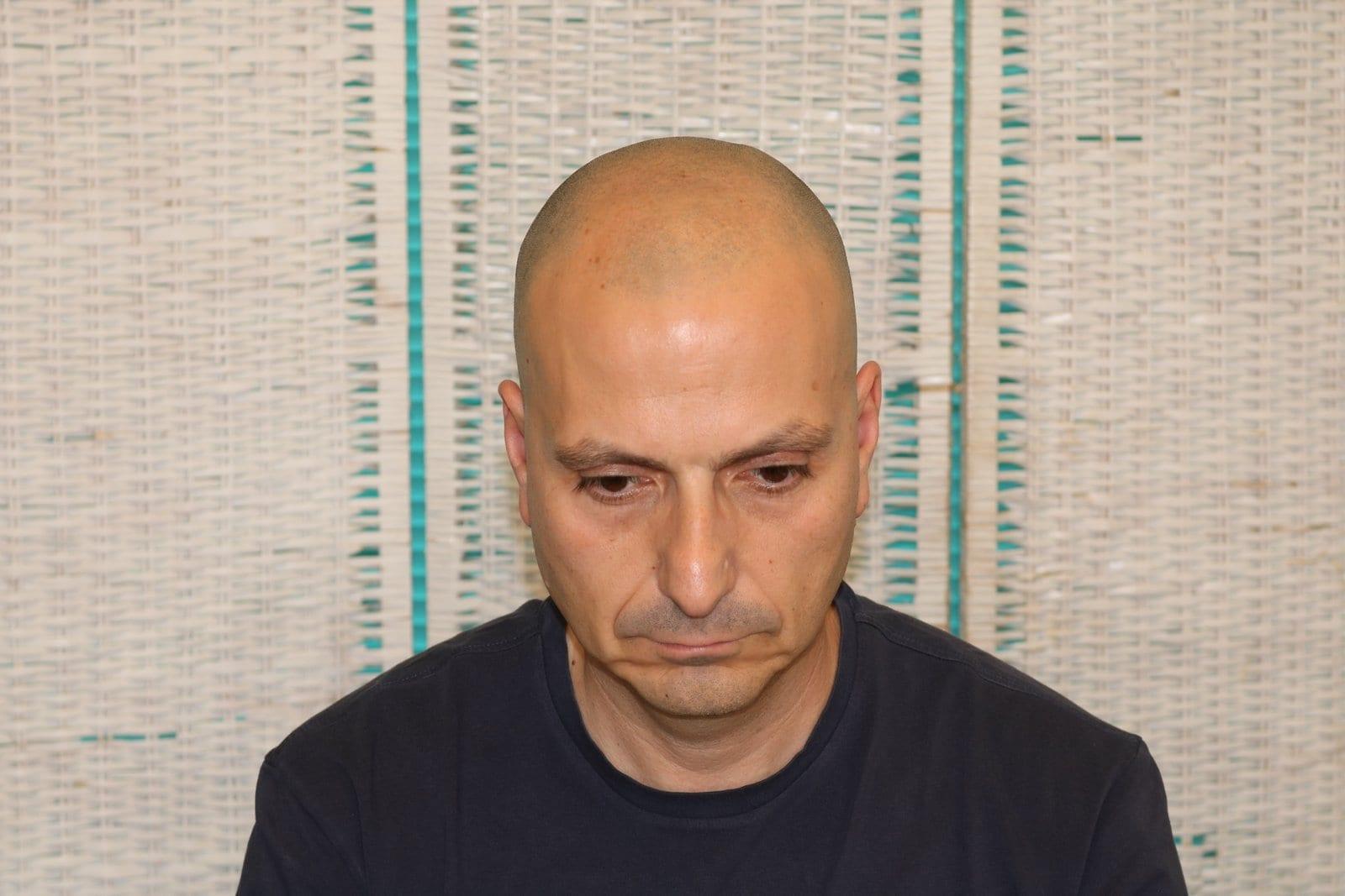 Prima: tricopigmentazione effetto rasato a Firenze — Caso Prima / Dopo #38 (foto 3)