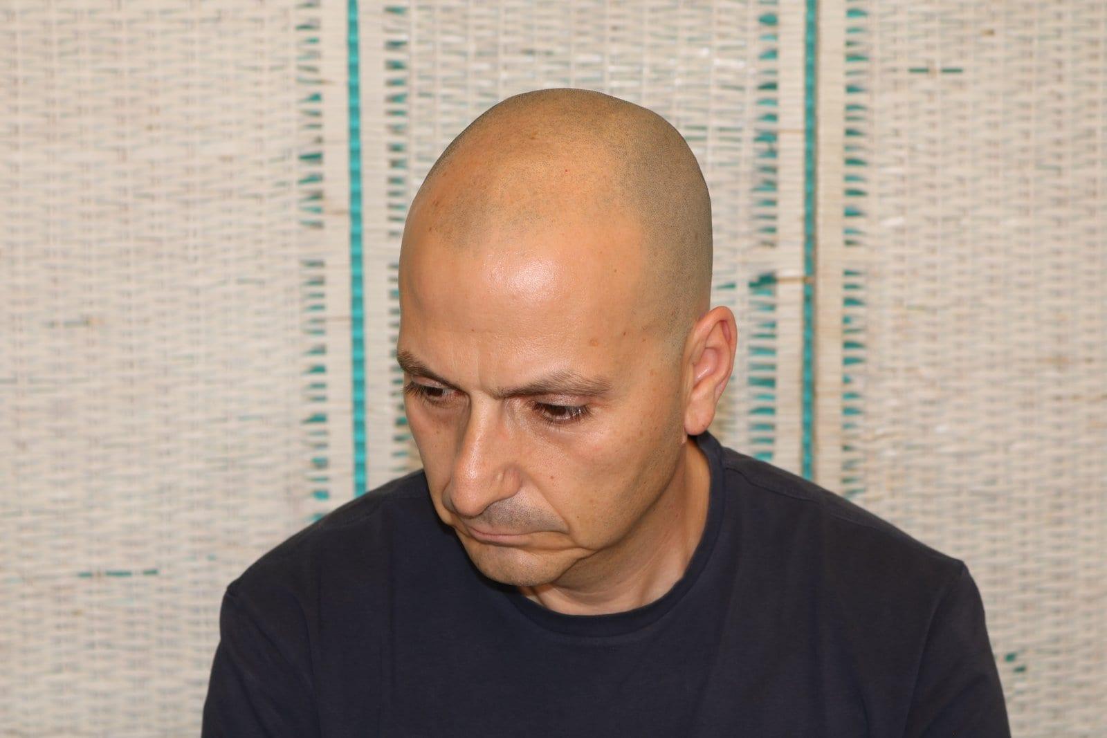 Prima: tricopigmentazione effetto rasato a Firenze — Caso Prima / Dopo #38 (foto 4)