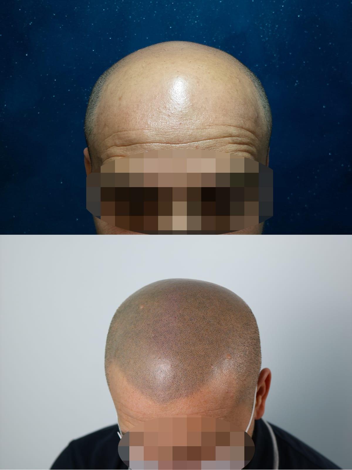 Prima e dopo: tricopigmentazione effetto rasato a Firenze — Caso studio #35 (foto 2)