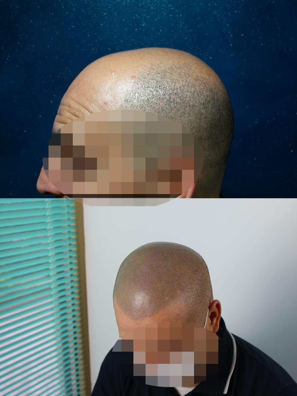 Prima e dopo: tricopigmentazione effetto rasato a Firenze — Caso studio #35 (foto 3)