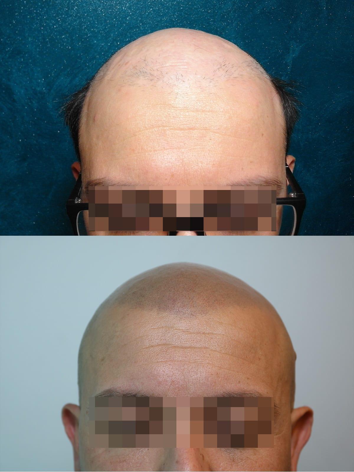 Prima e dopo: tricopigmentazione effetto rasato a Firenze — Caso studio #39 (foto 2)