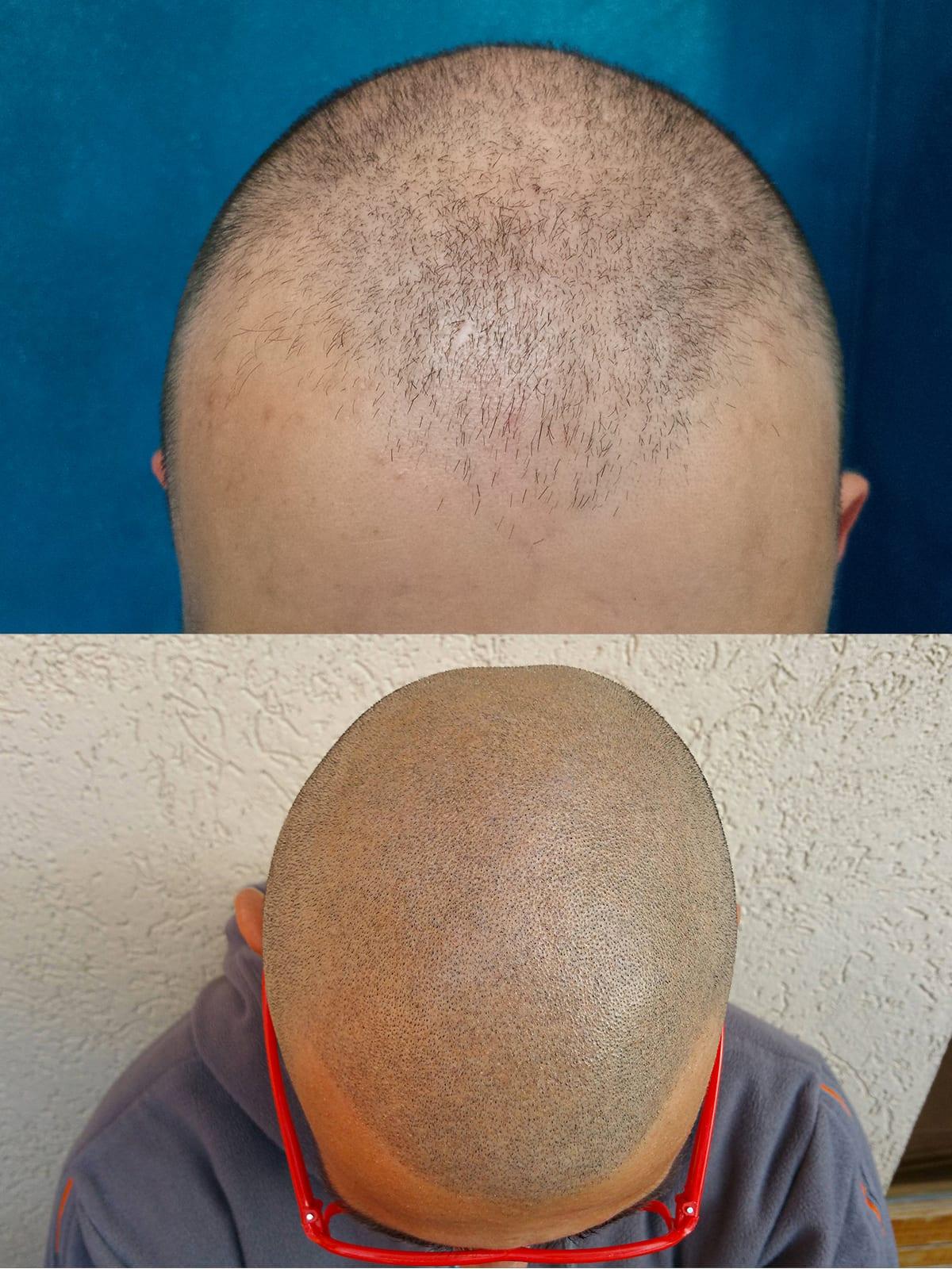 Tricopigmentazione, prima e dopo, caso #44, Firenze