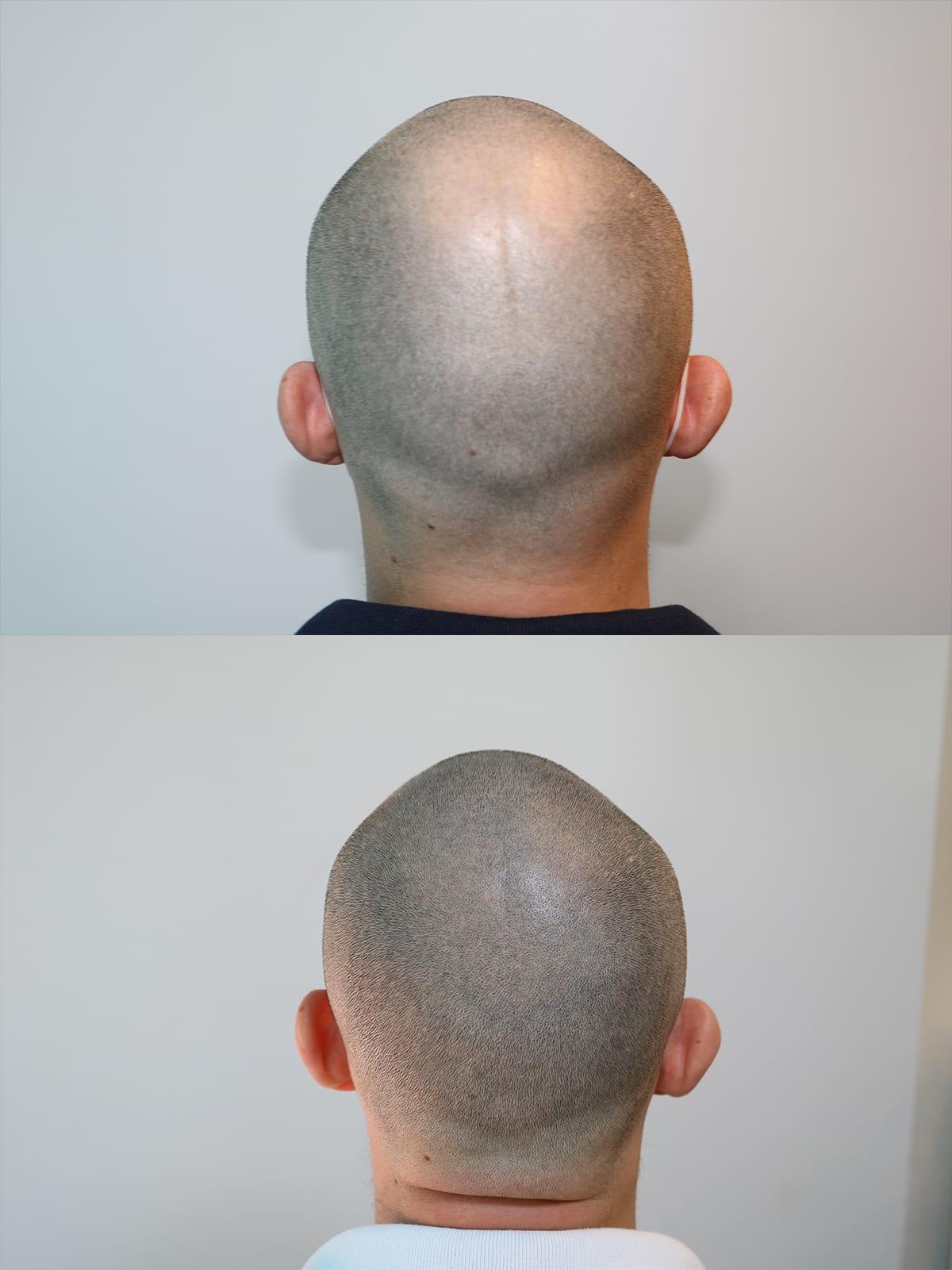 Prima e dopo: tricopigmentazione effetto rasato a Firenze — Caso studio #46 (foto 2)