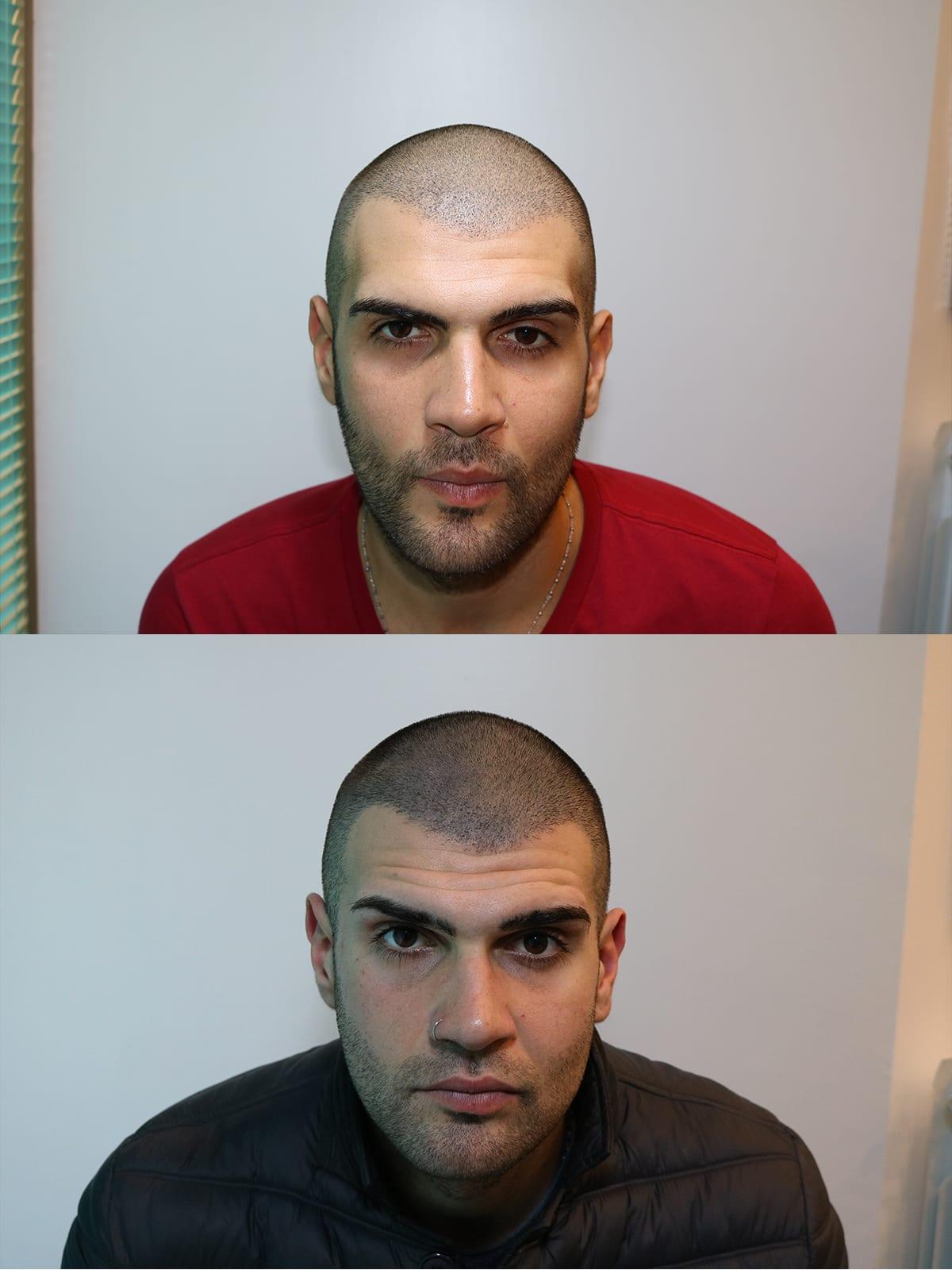 Tricopigmentazione, prima e dopo, caso #47, Firenze
