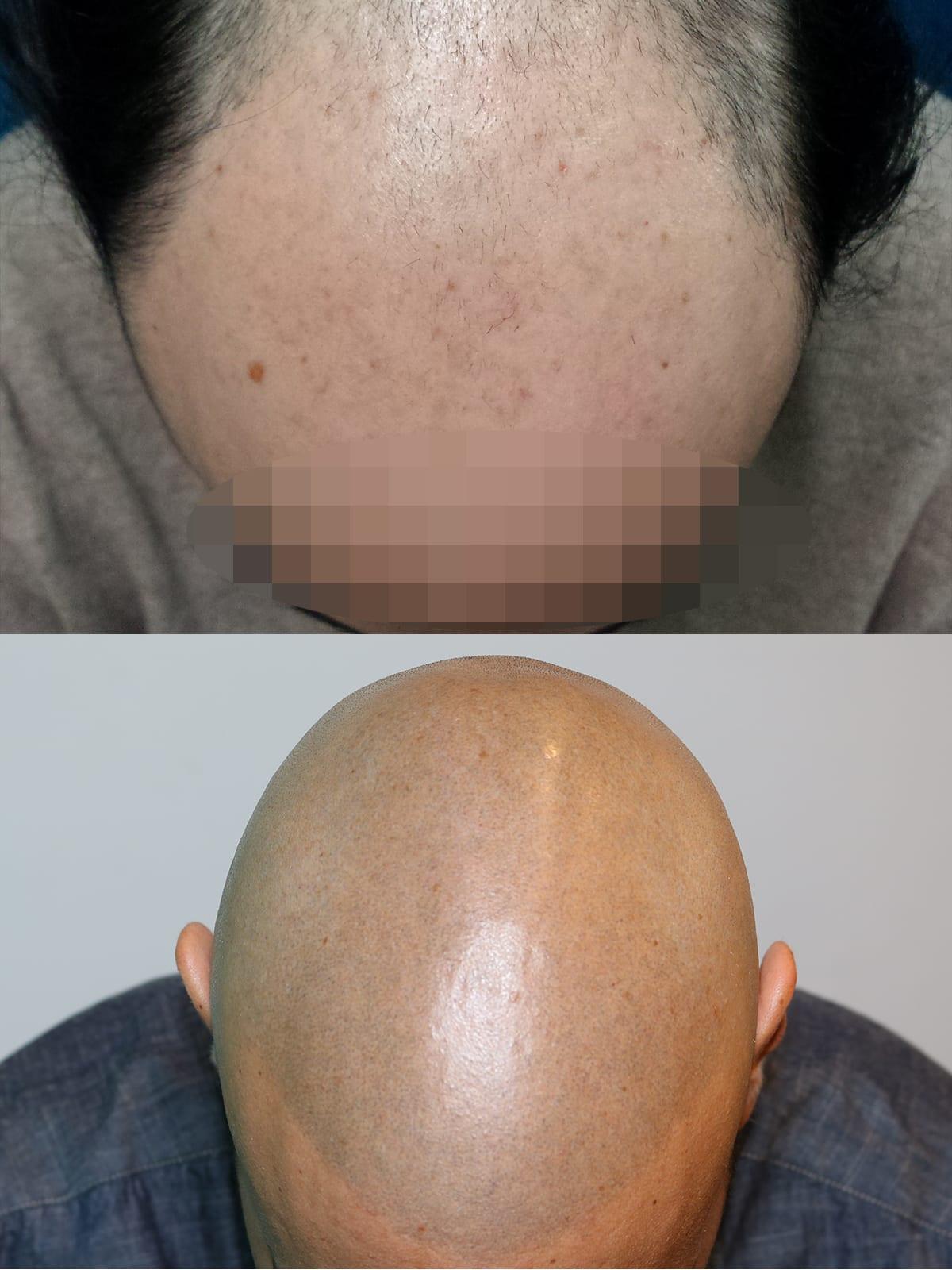 Prima e dopo: tricopigmentazione effetto rasato a Firenze — Caso studio #53 (foto 2)