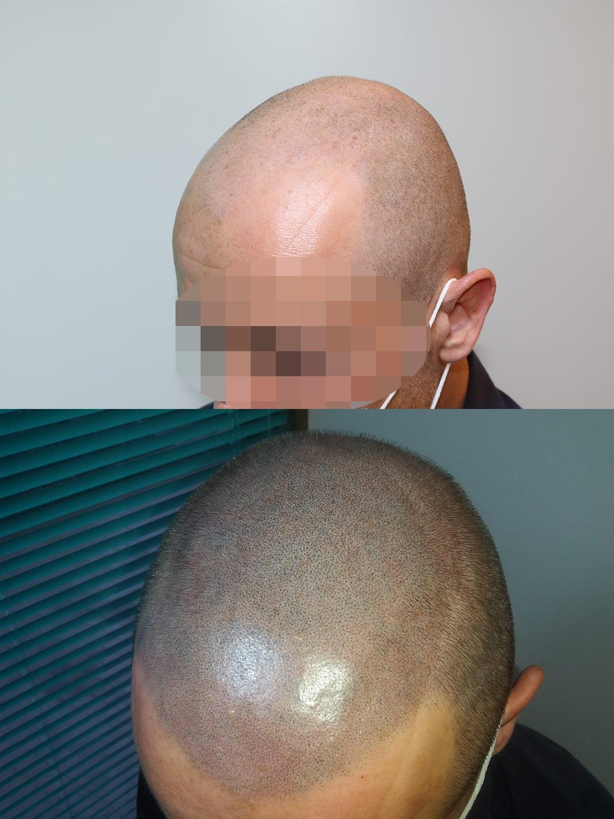 Tricopigmentazione, prima e dopo, caso #61, Firenze