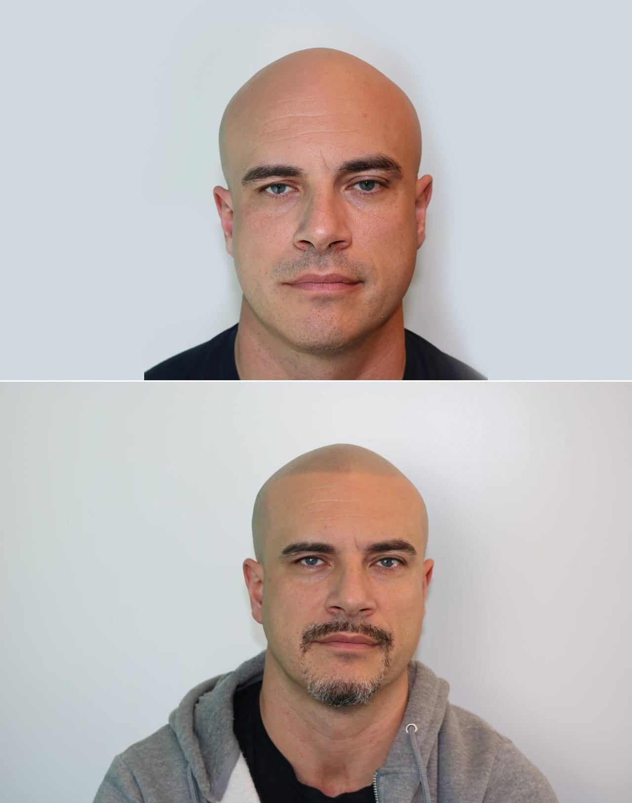 Tricopigmentazione, prima e dopo, caso #70, Firenze