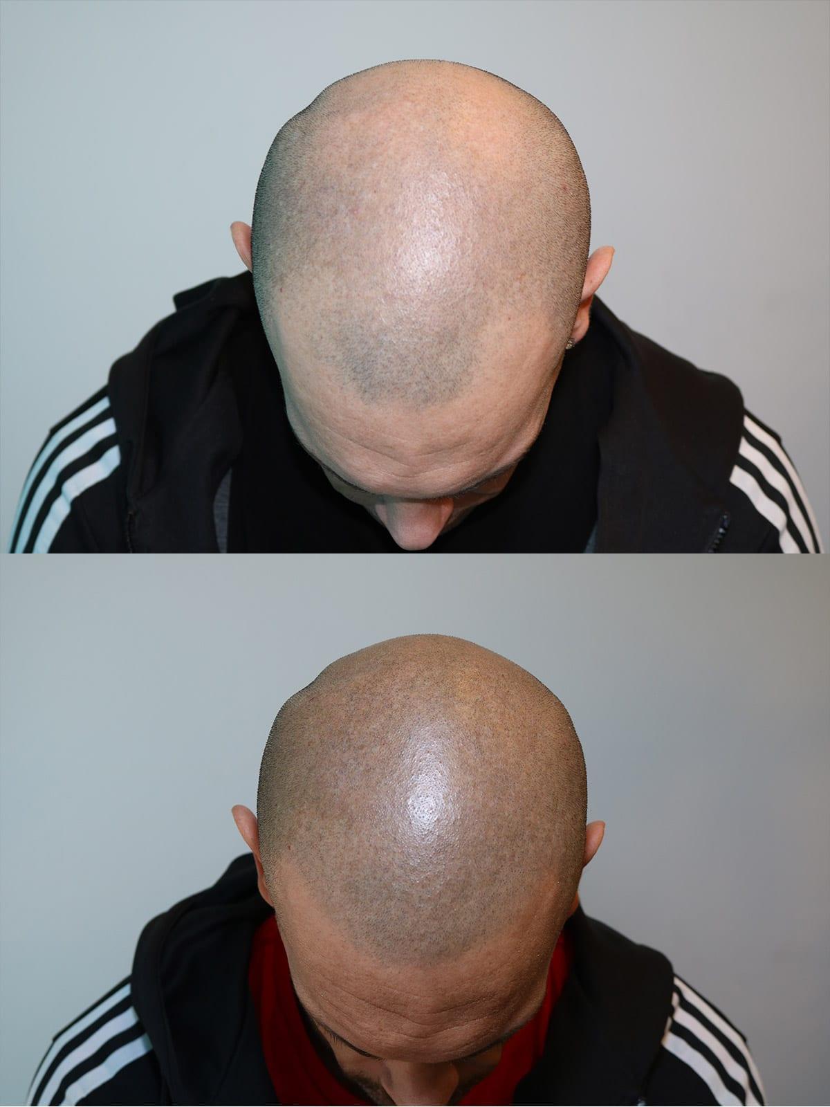 Prima e dopo: tricopigmentazione effetto rasato a Firenze — Caso studio #8 (foto 1)