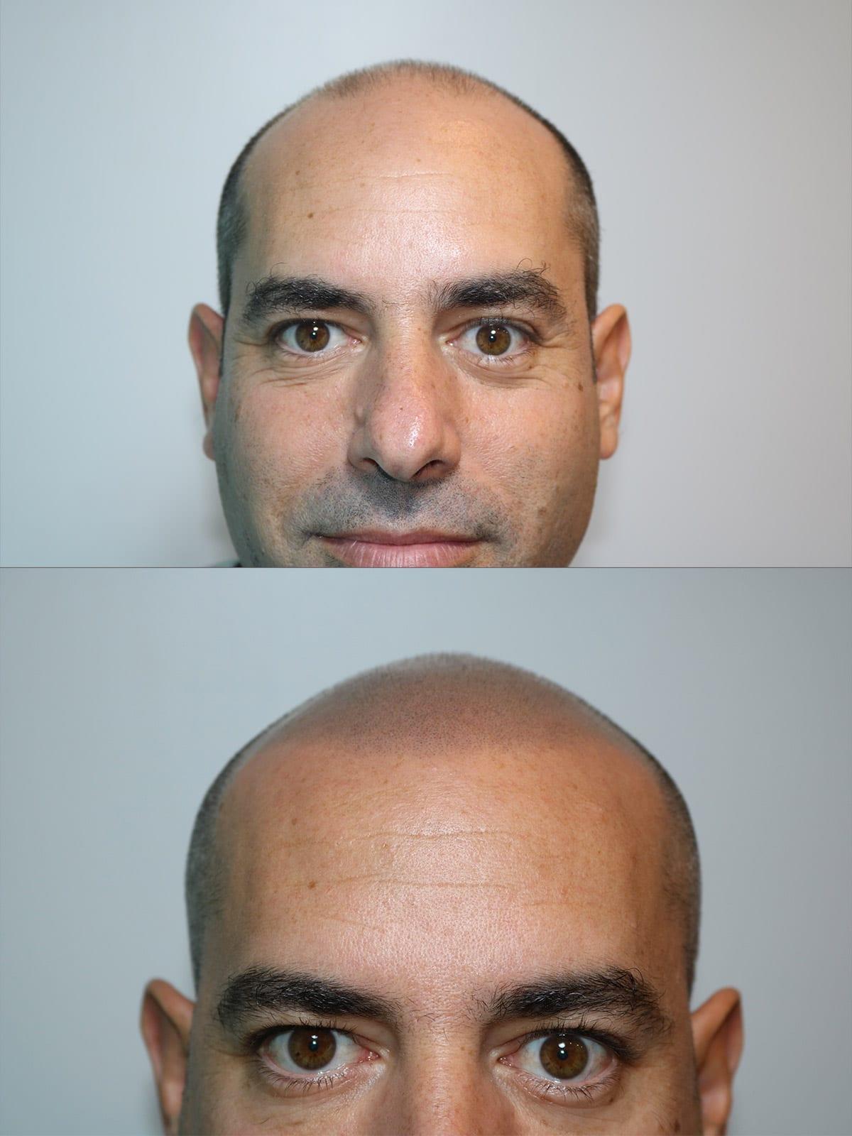 Prima e dopo: tricopigmentazione effetto rasato a Firenze — Caso studio #9 (foto 3)