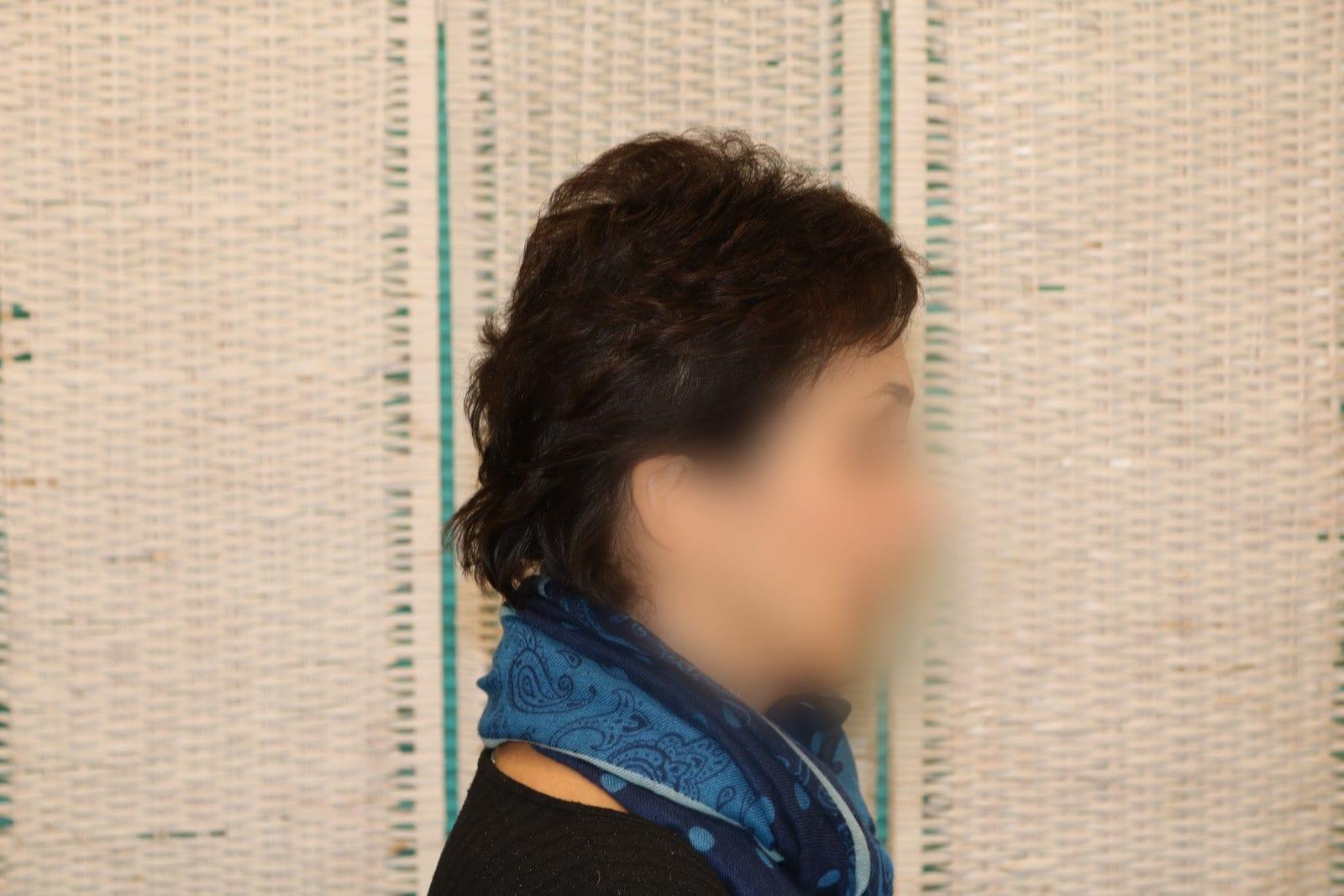 Tricopigmentazione, dopo, caso #10, Firenze