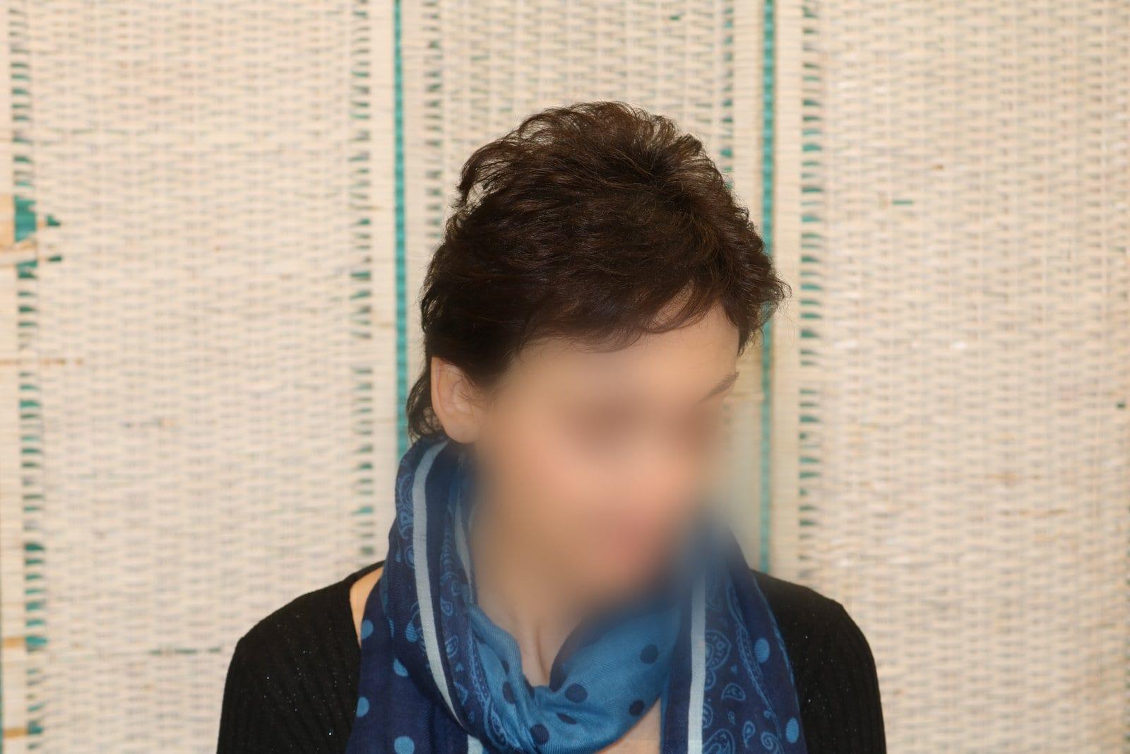Dopo: tricopigmentazione sezione donna a Firenze — Caso Prima / Dopo #10 (foto 2)