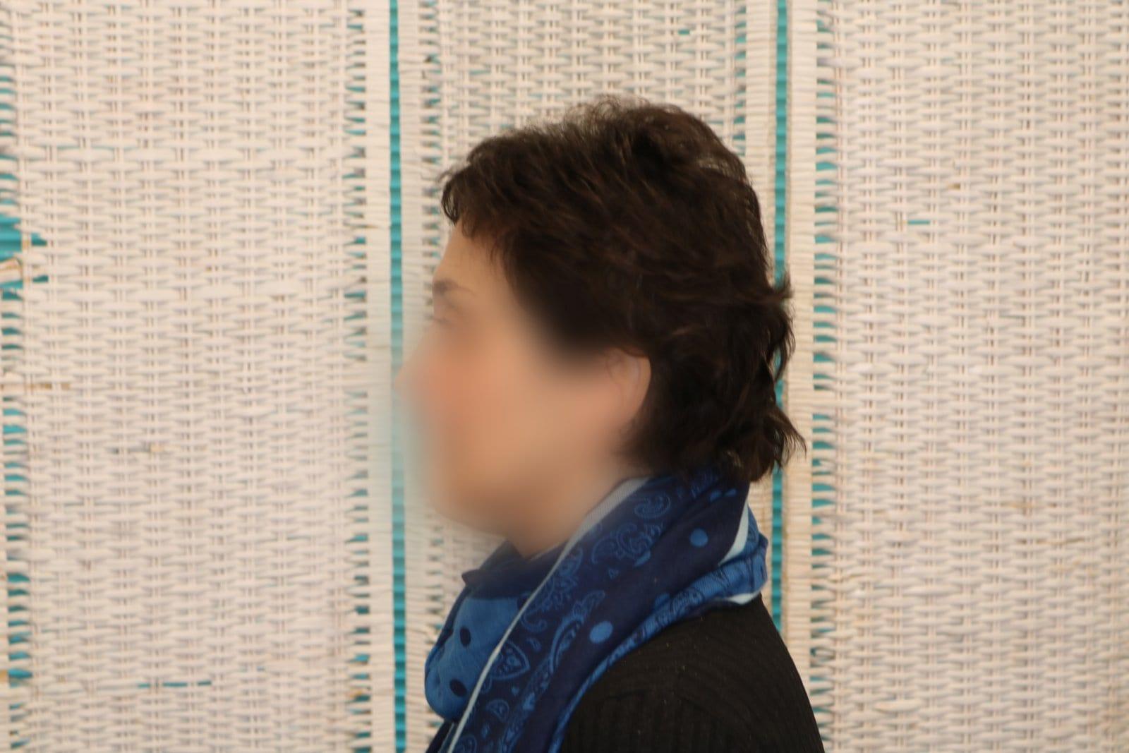 Dopo: tricopigmentazione sezione donna a Firenze — Caso Prima / Dopo #10 (foto 3)