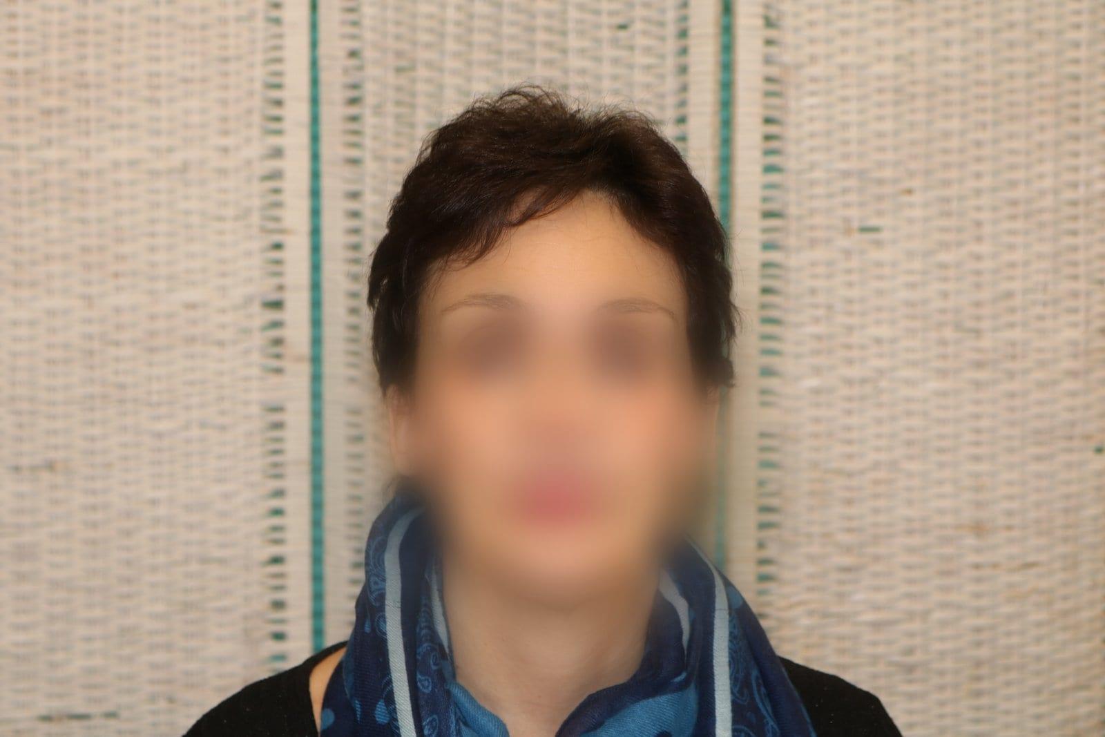 Dopo: tricopigmentazione sezione donna a Firenze — Caso Prima / Dopo #10 (foto 4)