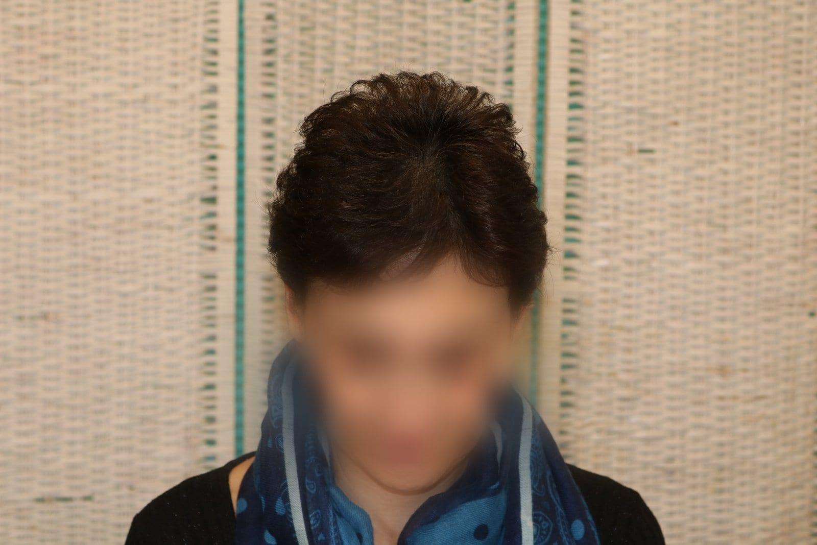 Dopo: tricopigmentazione sezione donna a Firenze — Caso Prima / Dopo #10 (foto 5)