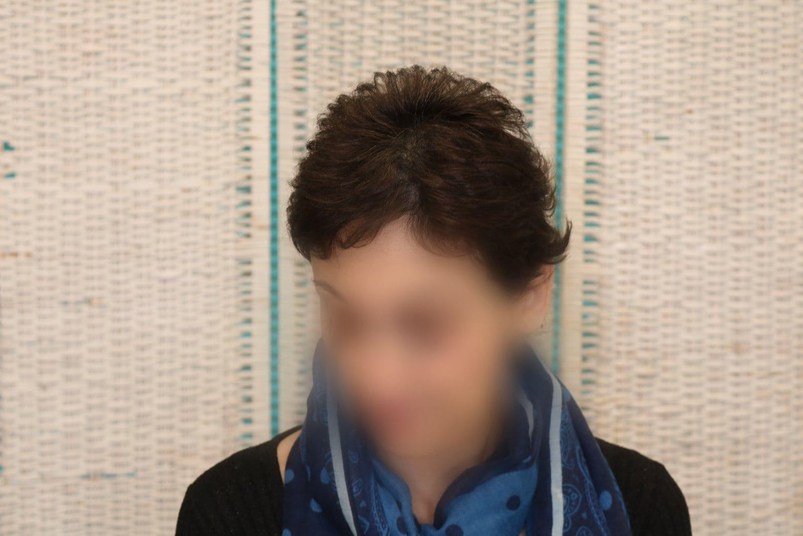 Dopo: tricopigmentazione sezione donna a Firenze — Caso Prima / Dopo #10 (foto 6)