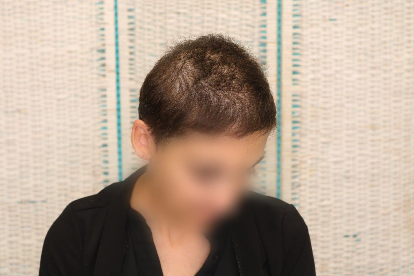 Prima: tricopigmentazione sezione donna a Firenze — Caso Prima / Dopo #10 (foto 1)