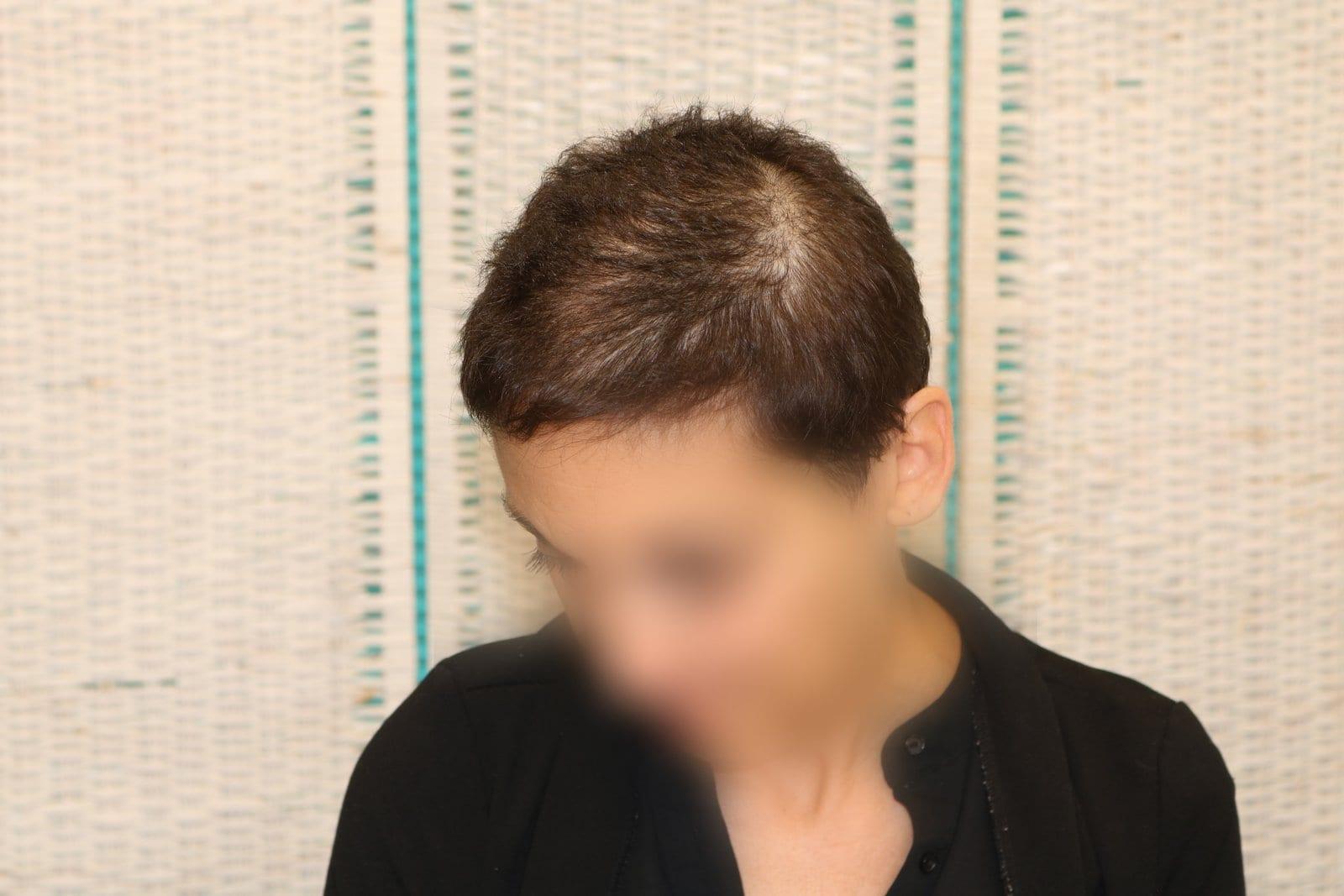 Prima: tricopigmentazione sezione donna a Firenze — Caso Prima / Dopo #10 (foto 3)