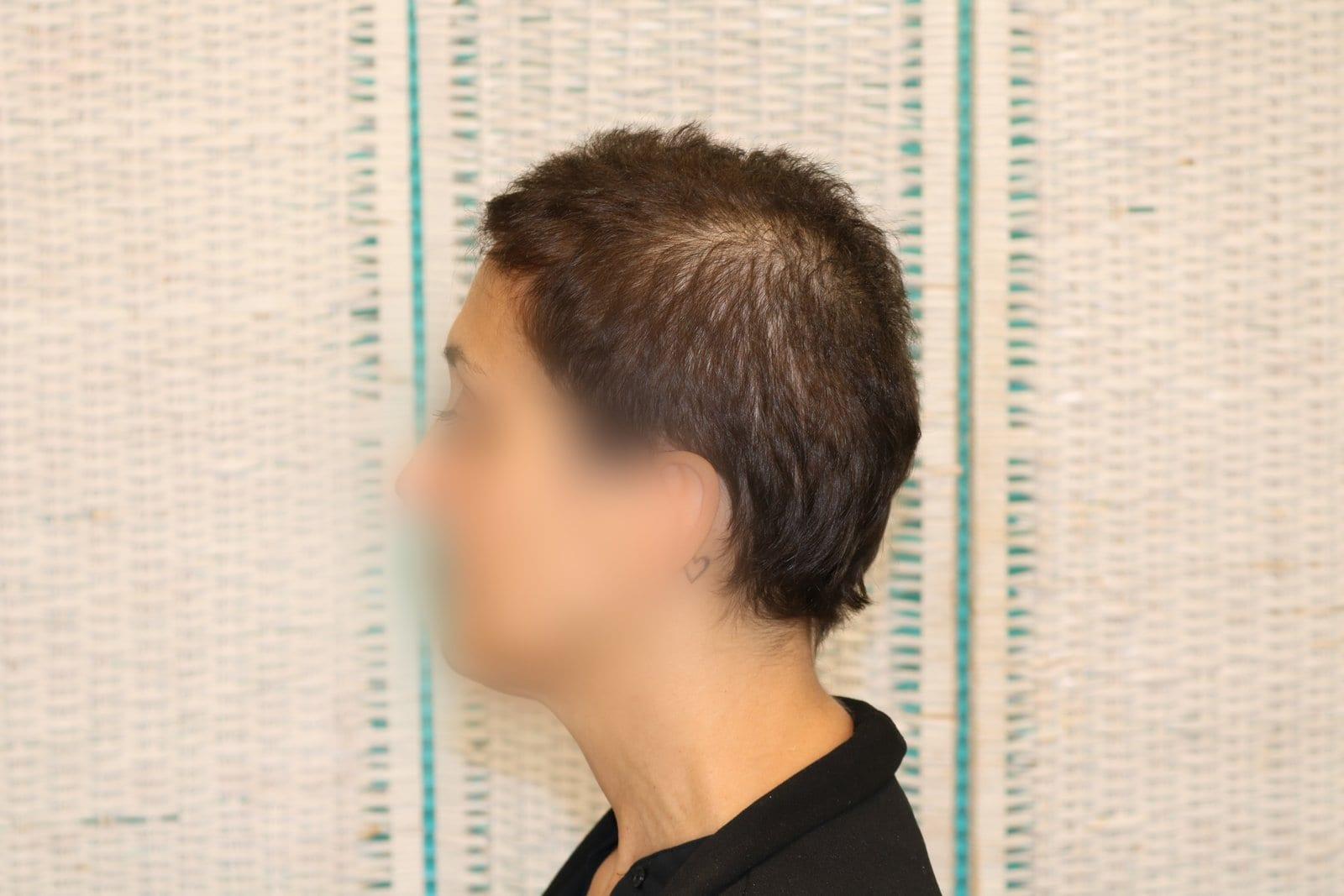 Prima: tricopigmentazione sezione donna a Firenze — Caso Prima / Dopo #10 (foto 4)