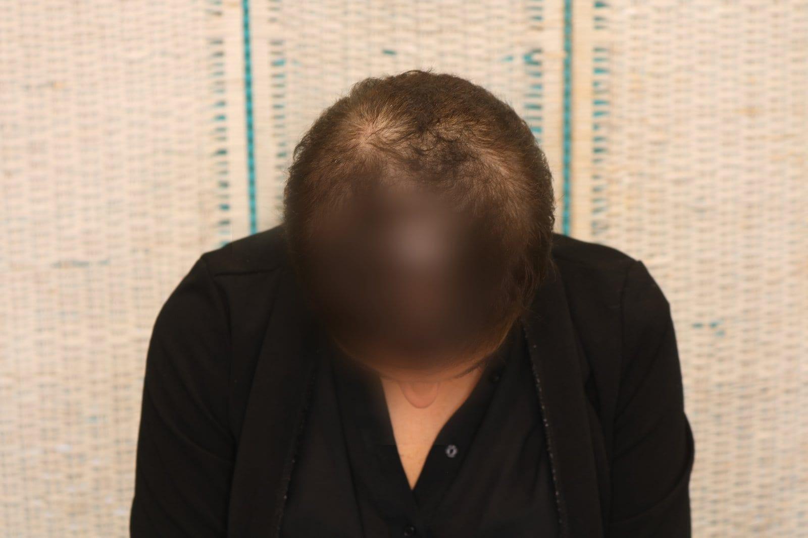 Prima: tricopigmentazione sezione donna a Firenze — Caso Prima / Dopo #10 (foto 6)
