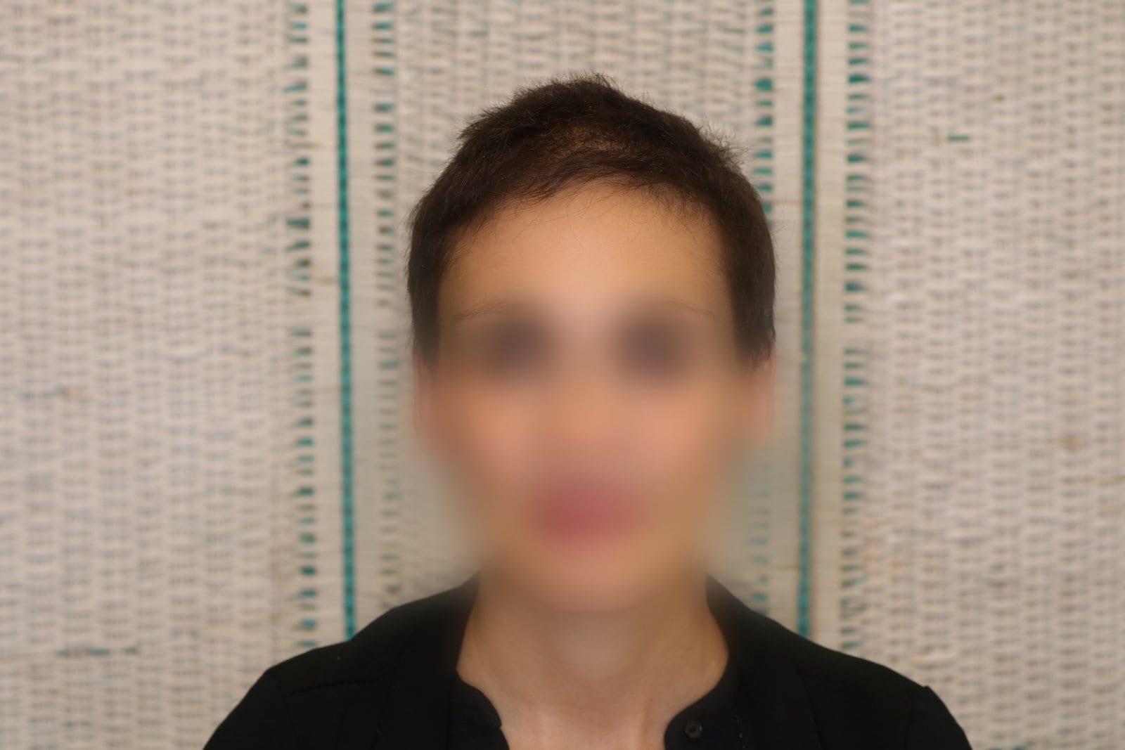 Prima: tricopigmentazione sezione donna a Firenze — Caso Prima / Dopo #10 (foto 7)