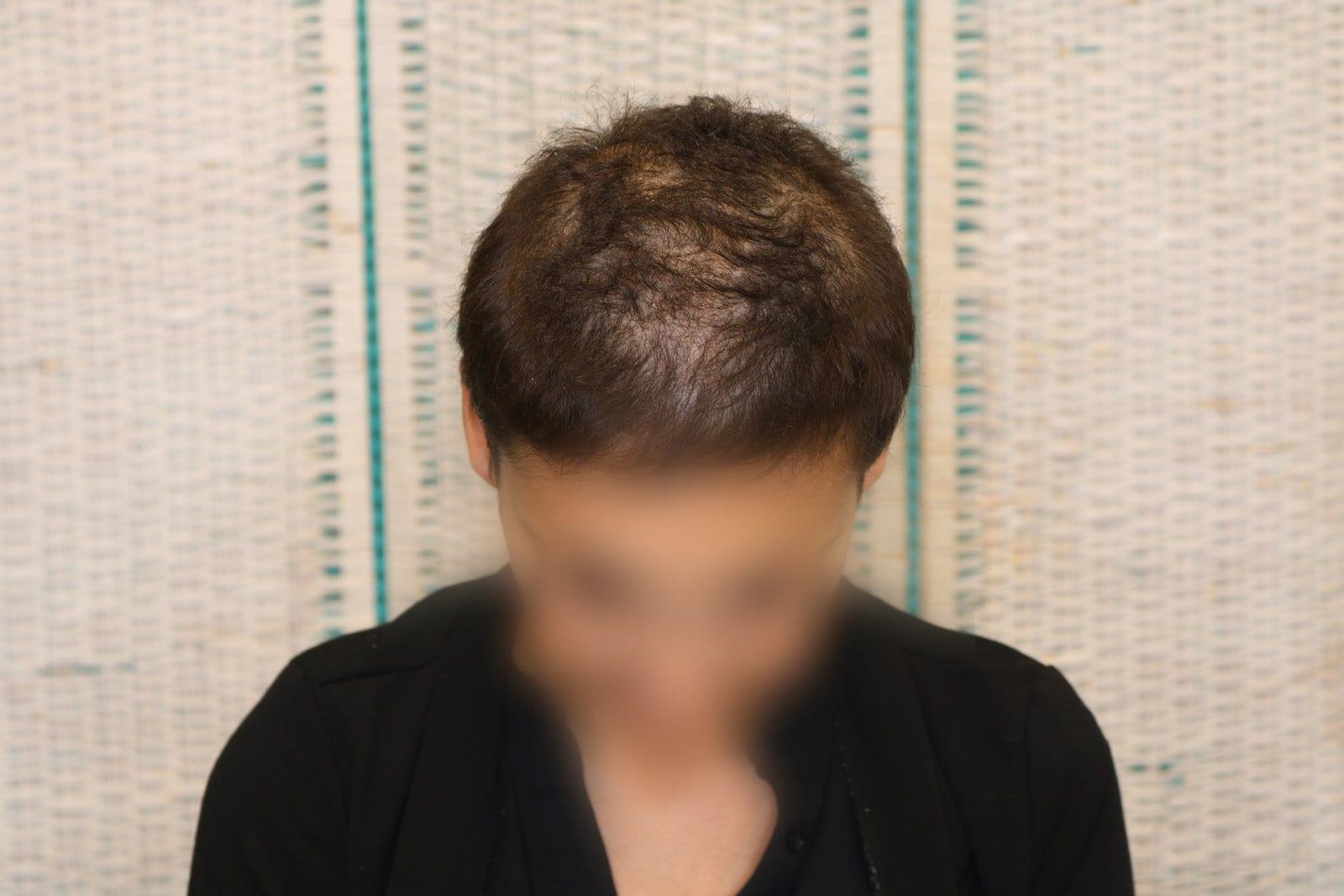 Prima: tricopigmentazione sezione donna a Firenze — Caso Prima / Dopo #10 (foto 8)