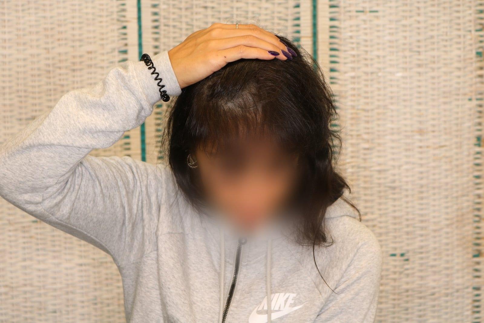 Dopo: tricopigmentazione sezione donna a Firenze — Caso Prima / Dopo #11 (foto 3)