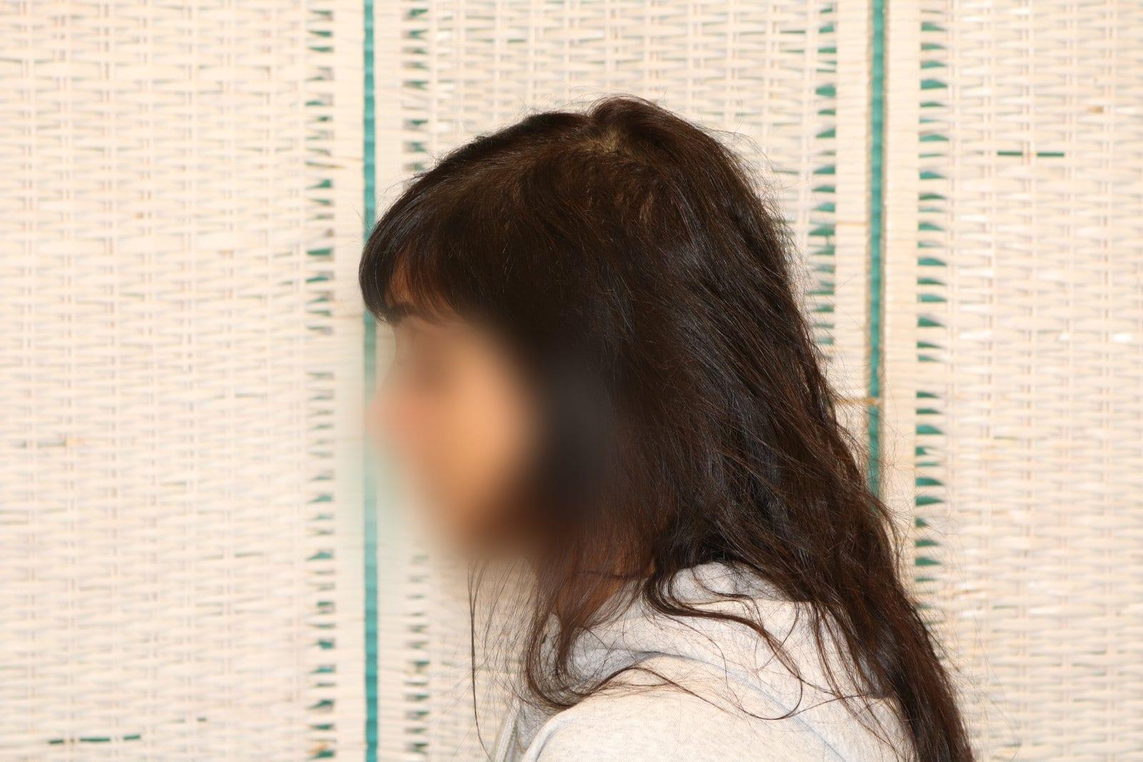Dopo: tricopigmentazione sezione donna a Firenze — Caso Prima / Dopo #11 (foto 4)