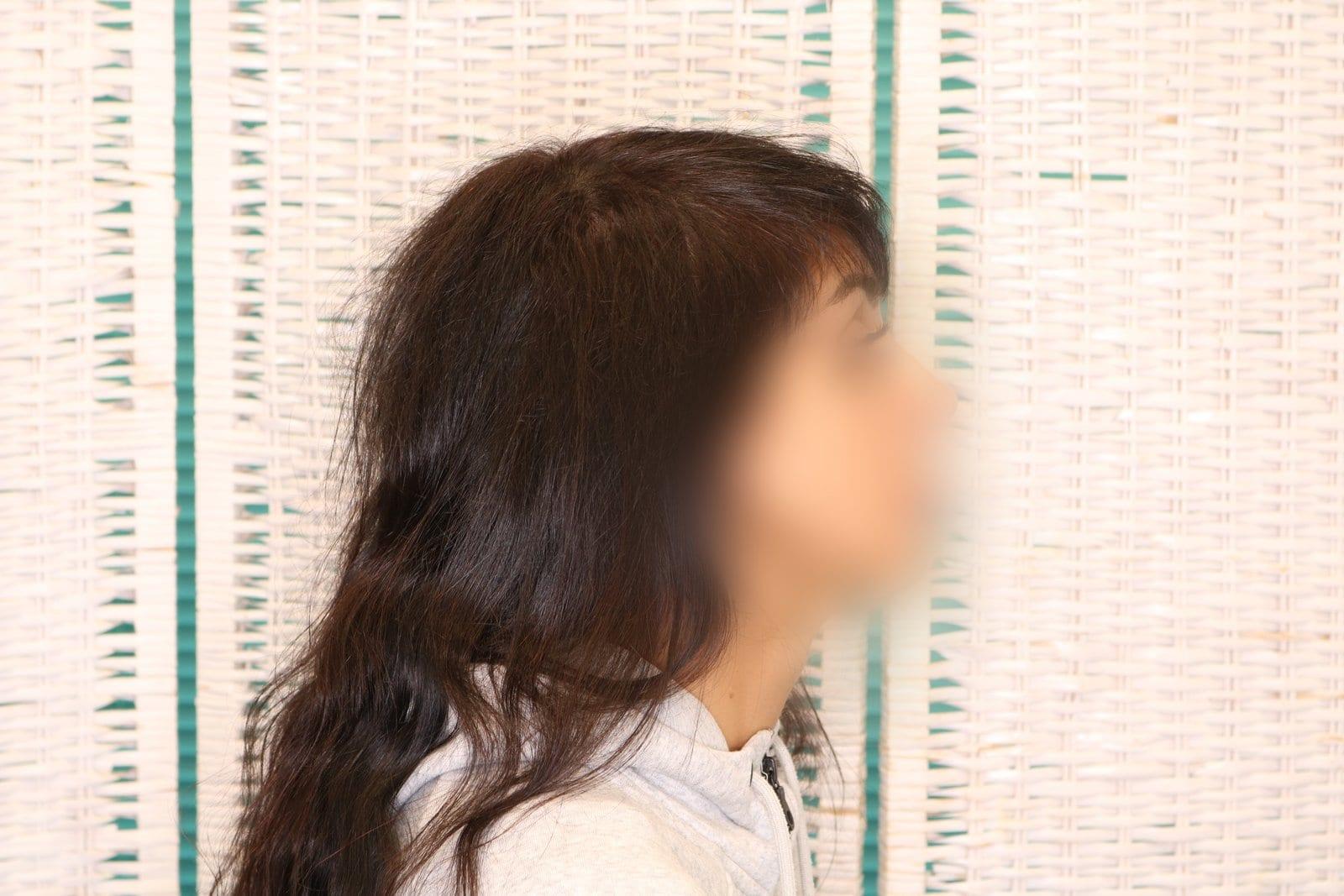 Dopo: tricopigmentazione sezione donna a Firenze — Caso Prima / Dopo #11 (foto 5)
