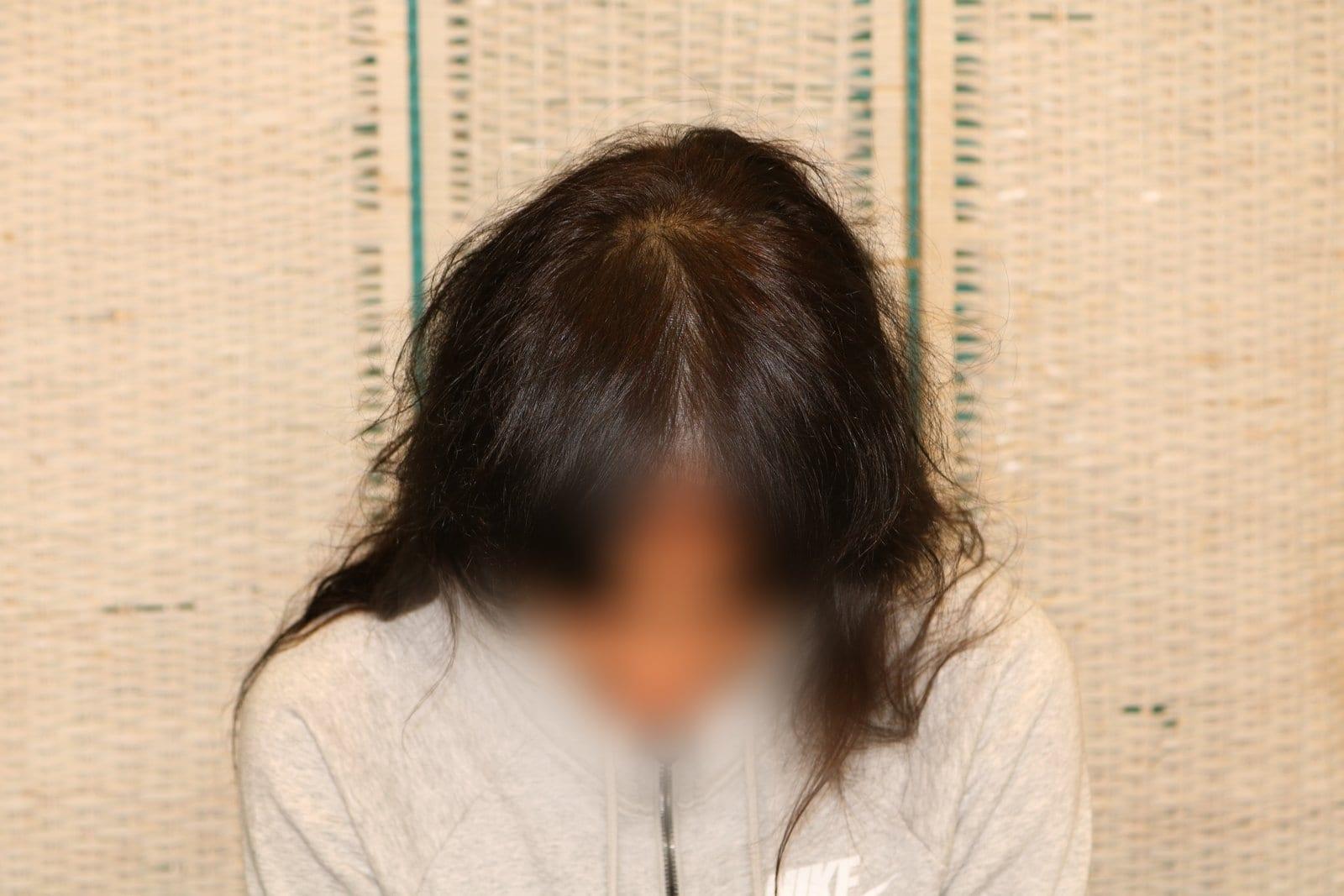 Dopo: tricopigmentazione sezione donna a Firenze — Caso Prima / Dopo #11 (foto 8)