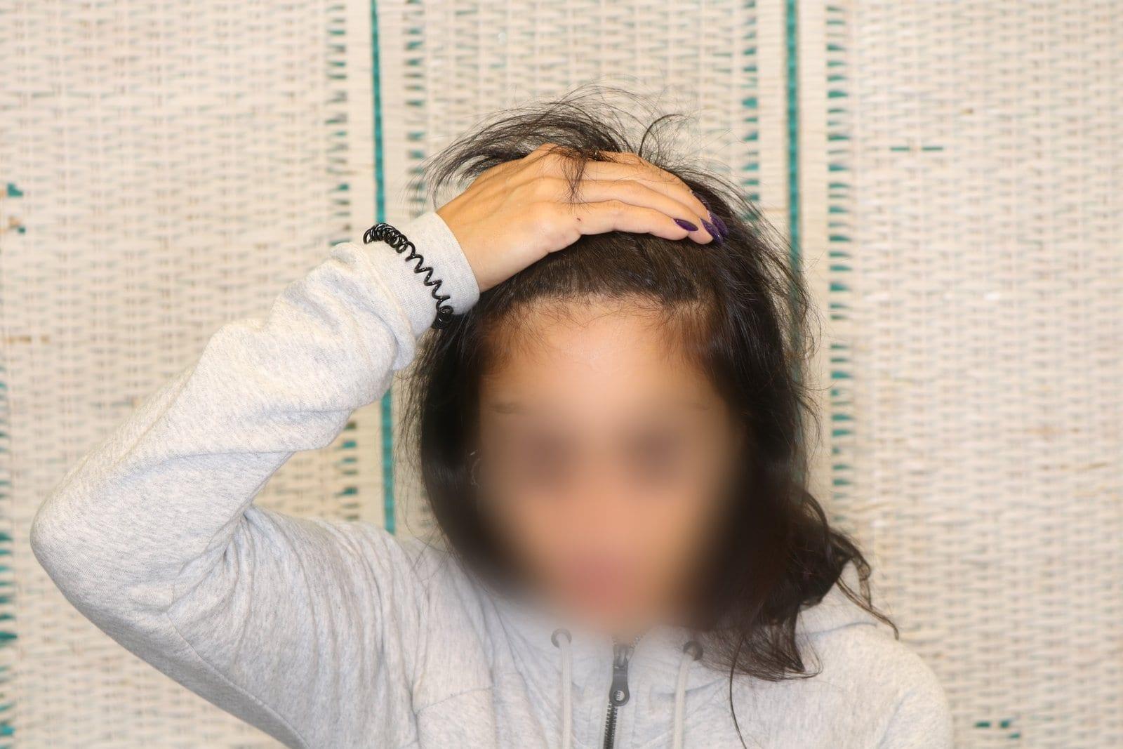 Dopo: tricopigmentazione sezione donna a Firenze — Caso Prima / Dopo #11 (foto 9)