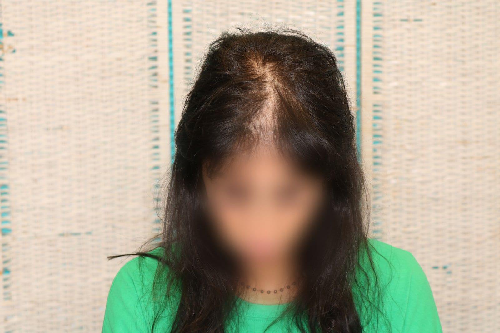 Prima: tricopigmentazione sezione donna a Firenze — Caso Prima / Dopo #11 (foto 2)