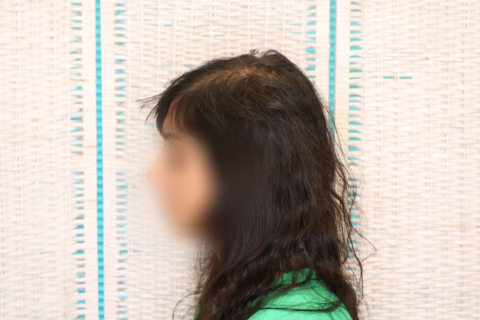 Prima: tricopigmentazione sezione donna a Firenze — Caso Prima / Dopo #11 (foto 3)