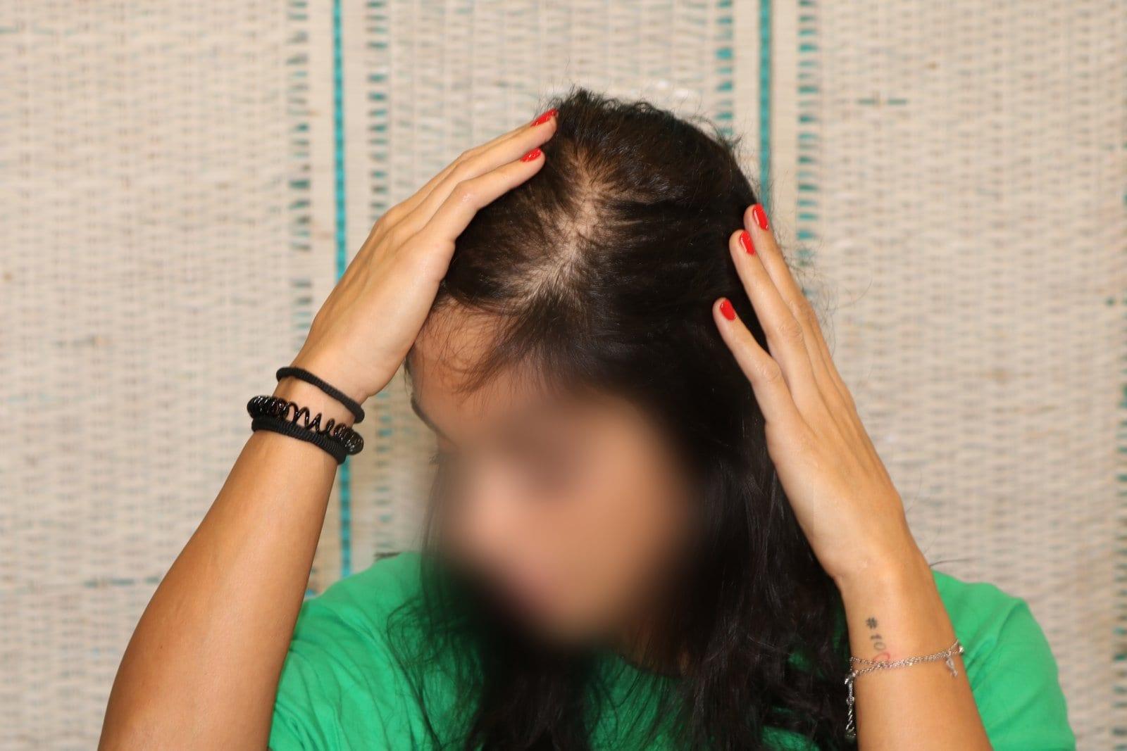 Prima: tricopigmentazione sezione donna a Firenze — Caso Prima / Dopo #11 (foto 4)