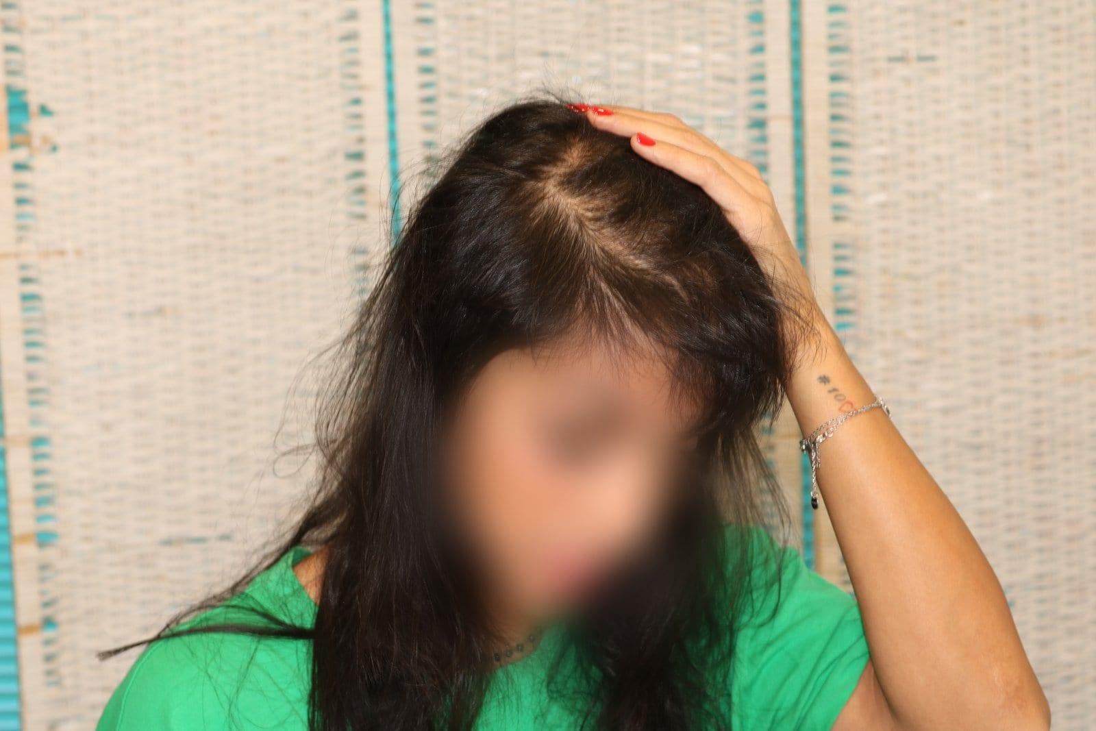 Prima: tricopigmentazione sezione donna a Firenze — Caso Prima / Dopo #11 (foto 5)