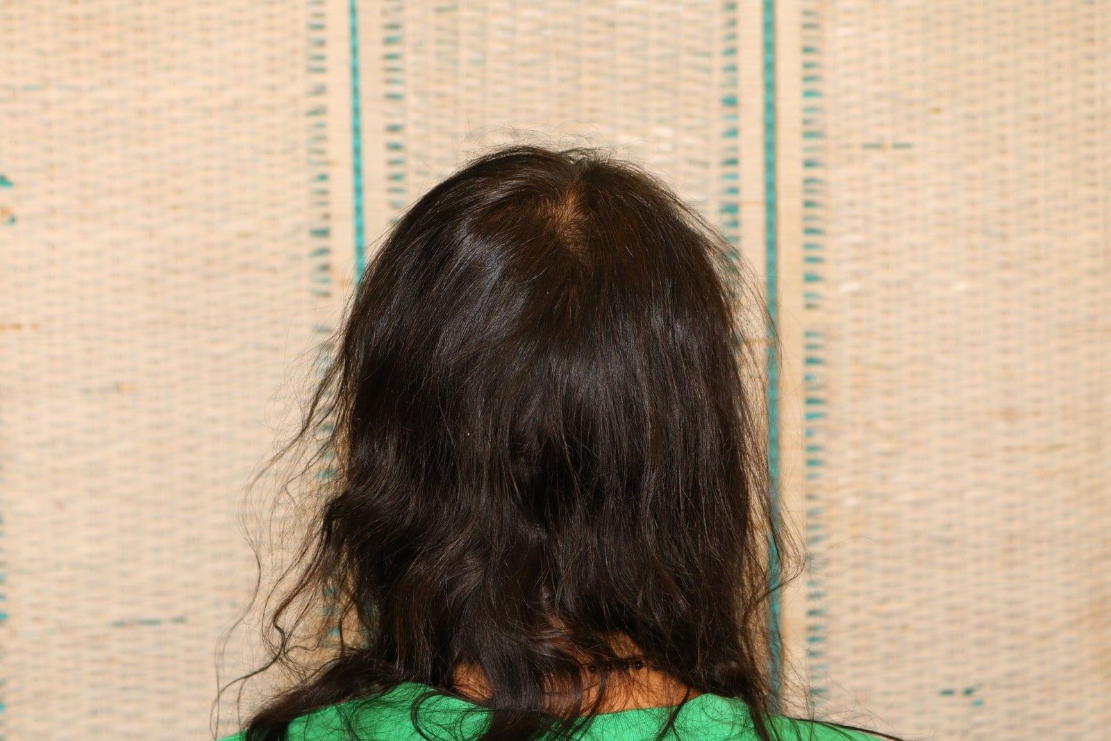 Prima: tricopigmentazione sezione donna a Firenze — Caso Prima / Dopo #11 (foto 6)