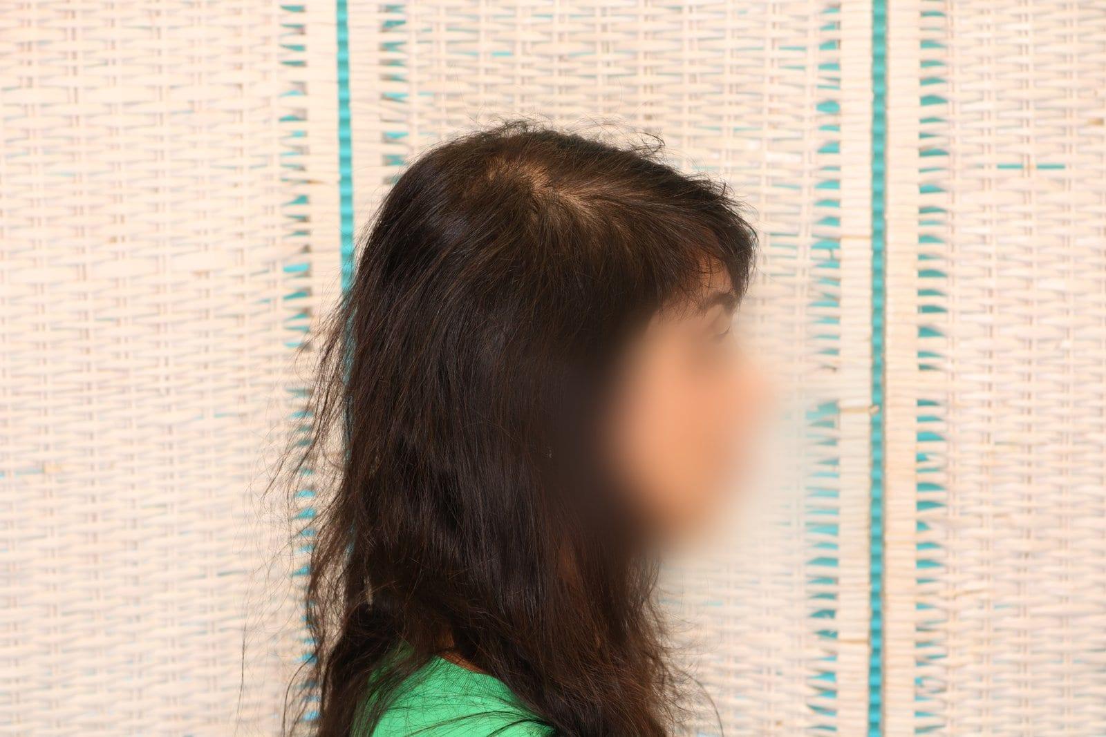 Prima: tricopigmentazione sezione donna a Firenze — Caso Prima / Dopo #11 (foto 8)