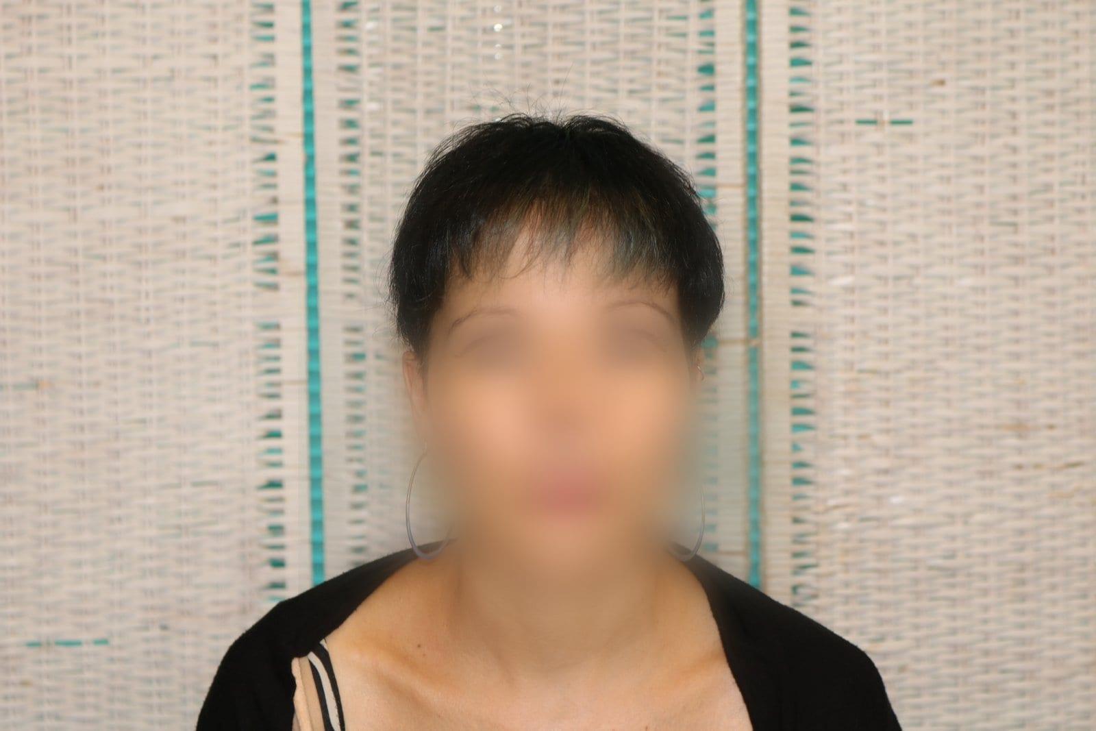 Dopo: tricopigmentazione sezione donna a Firenze — Caso Prima / Dopo #12 (foto 1)