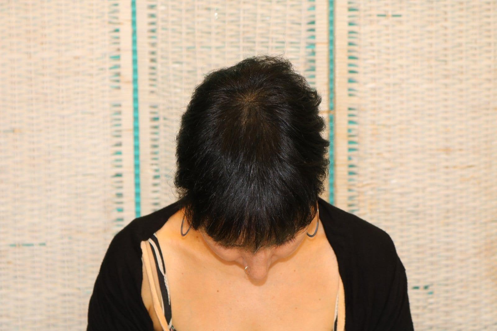 Dopo: tricopigmentazione sezione donna a Firenze — Caso Prima / Dopo #12 (foto 3)
